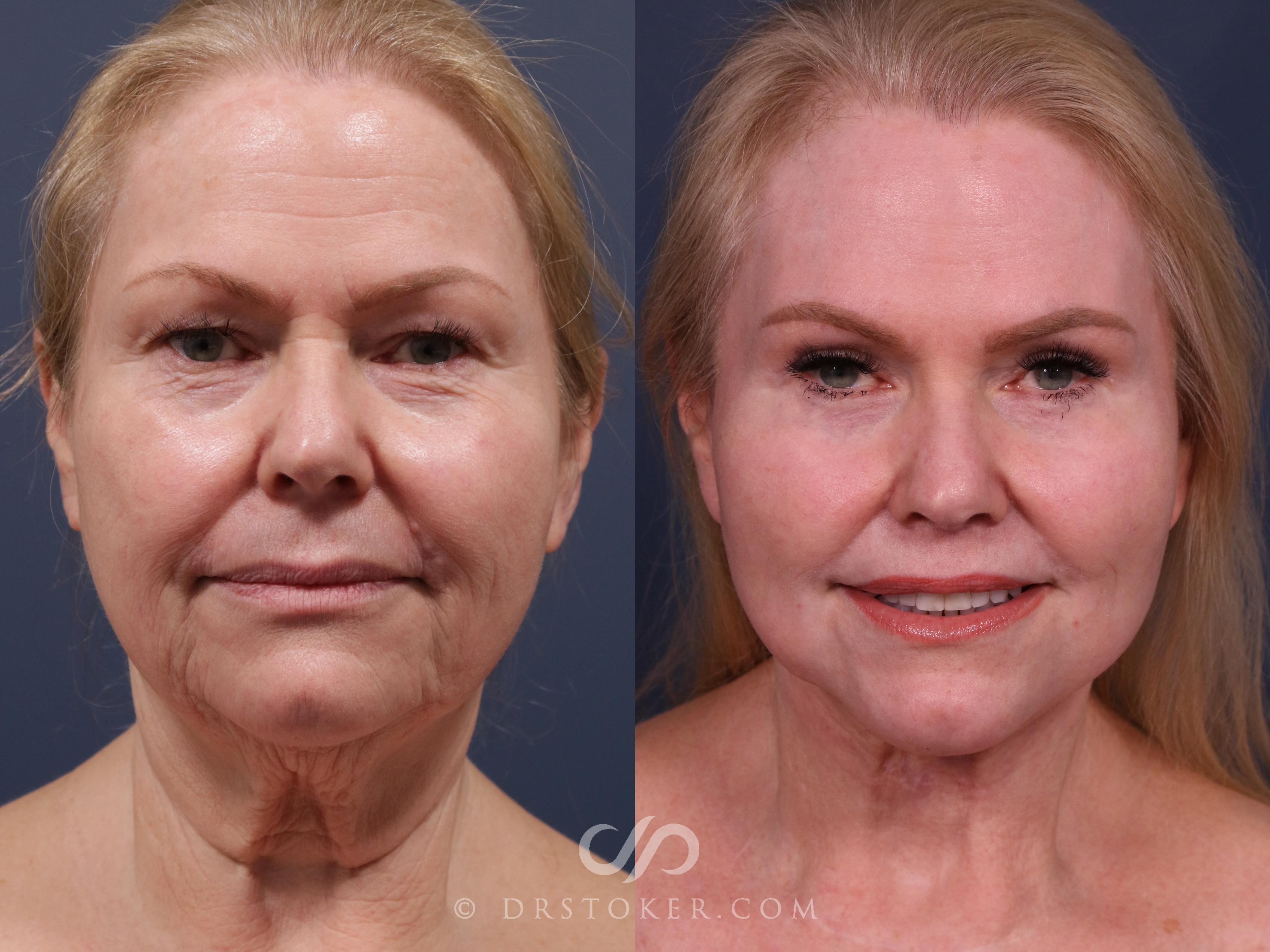 Before & After Facelift - Traceless Facelift Case 2303 Front View in Los Angeles, CA