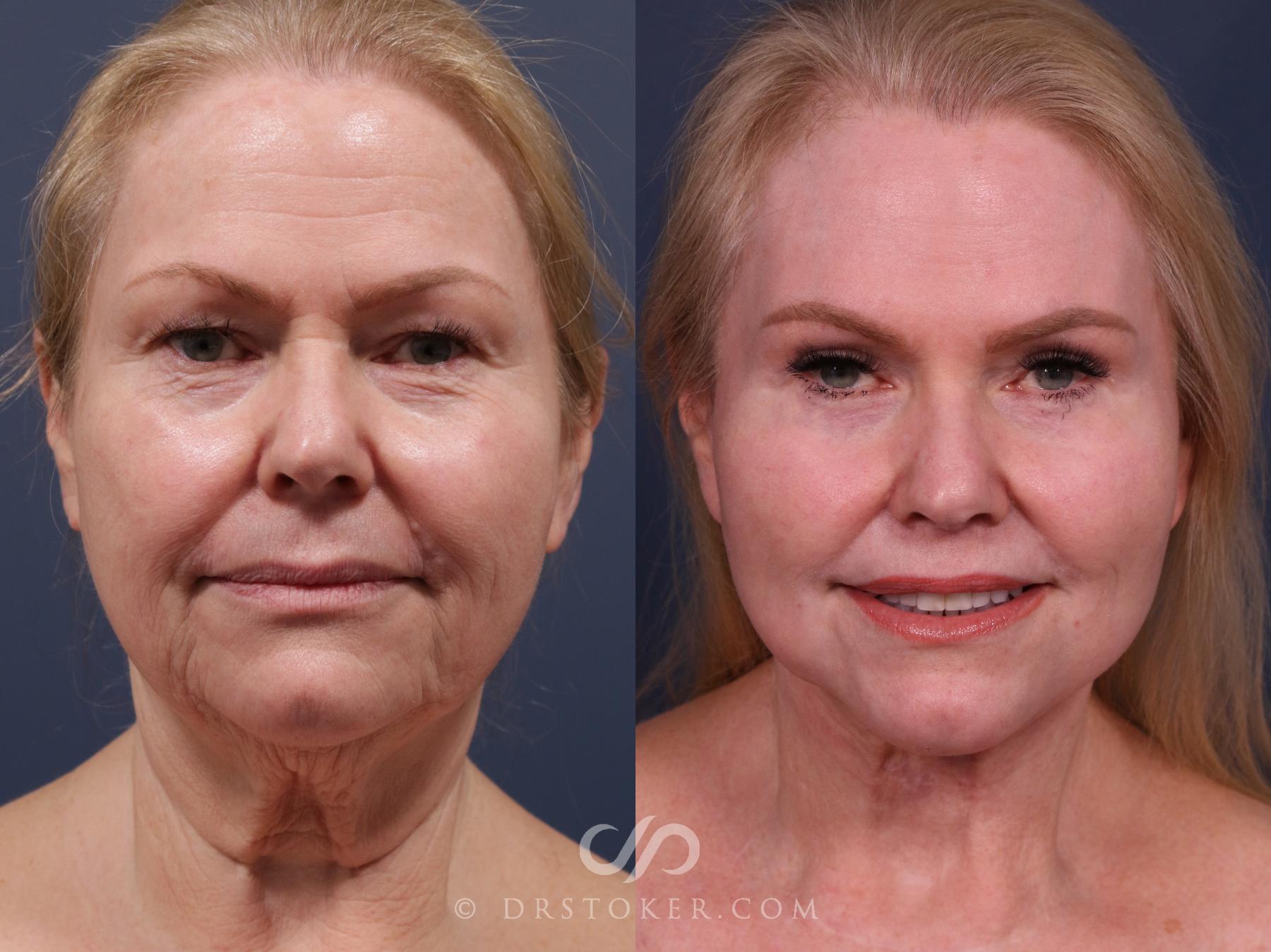 Before & After Facelift - Traceless Facelift Case 2303 Front View in Los Angeles, CA