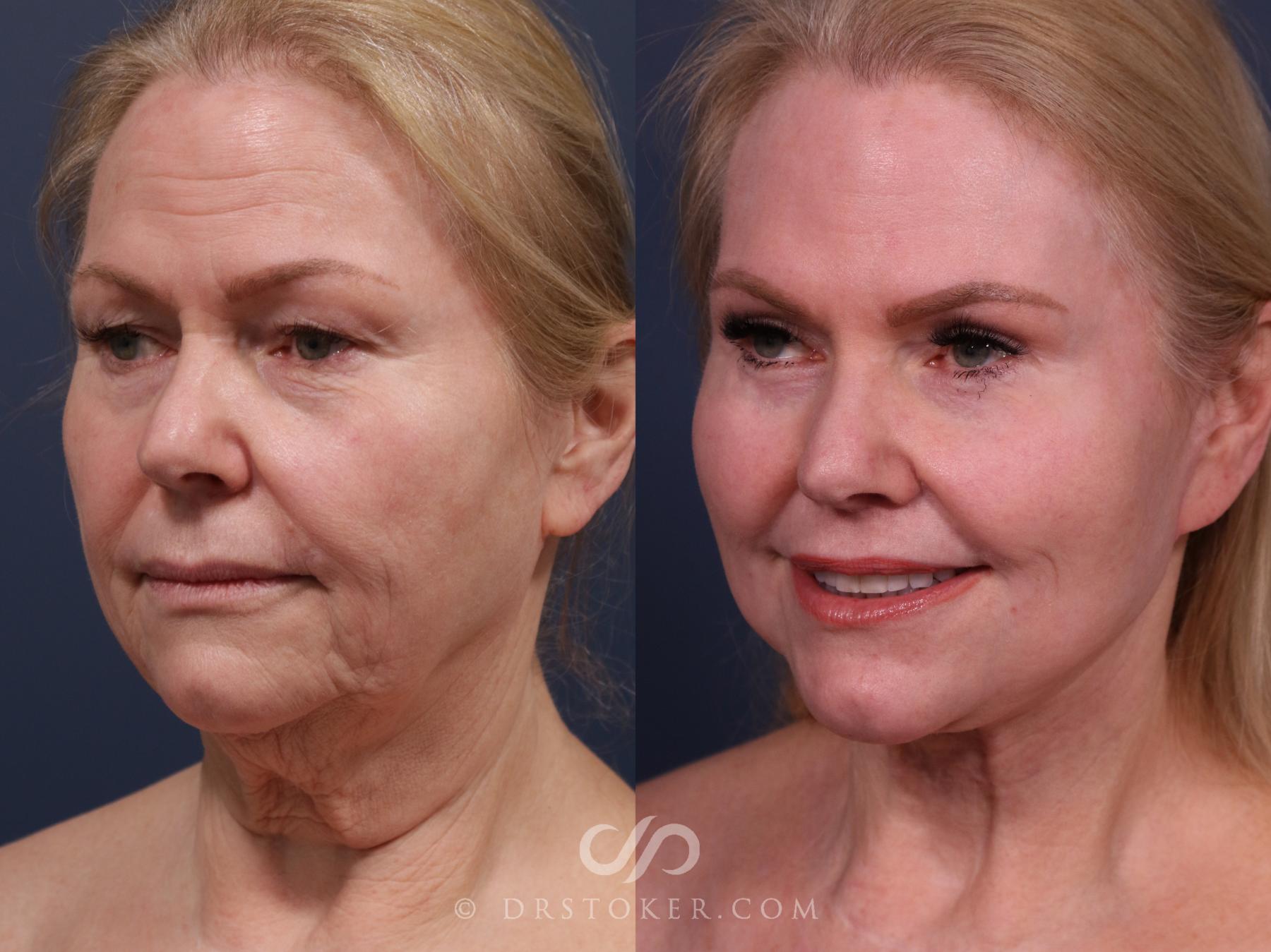 Before & After Facelift - Traceless Facelift Case 2303 Left Oblique View in Los Angeles, CA