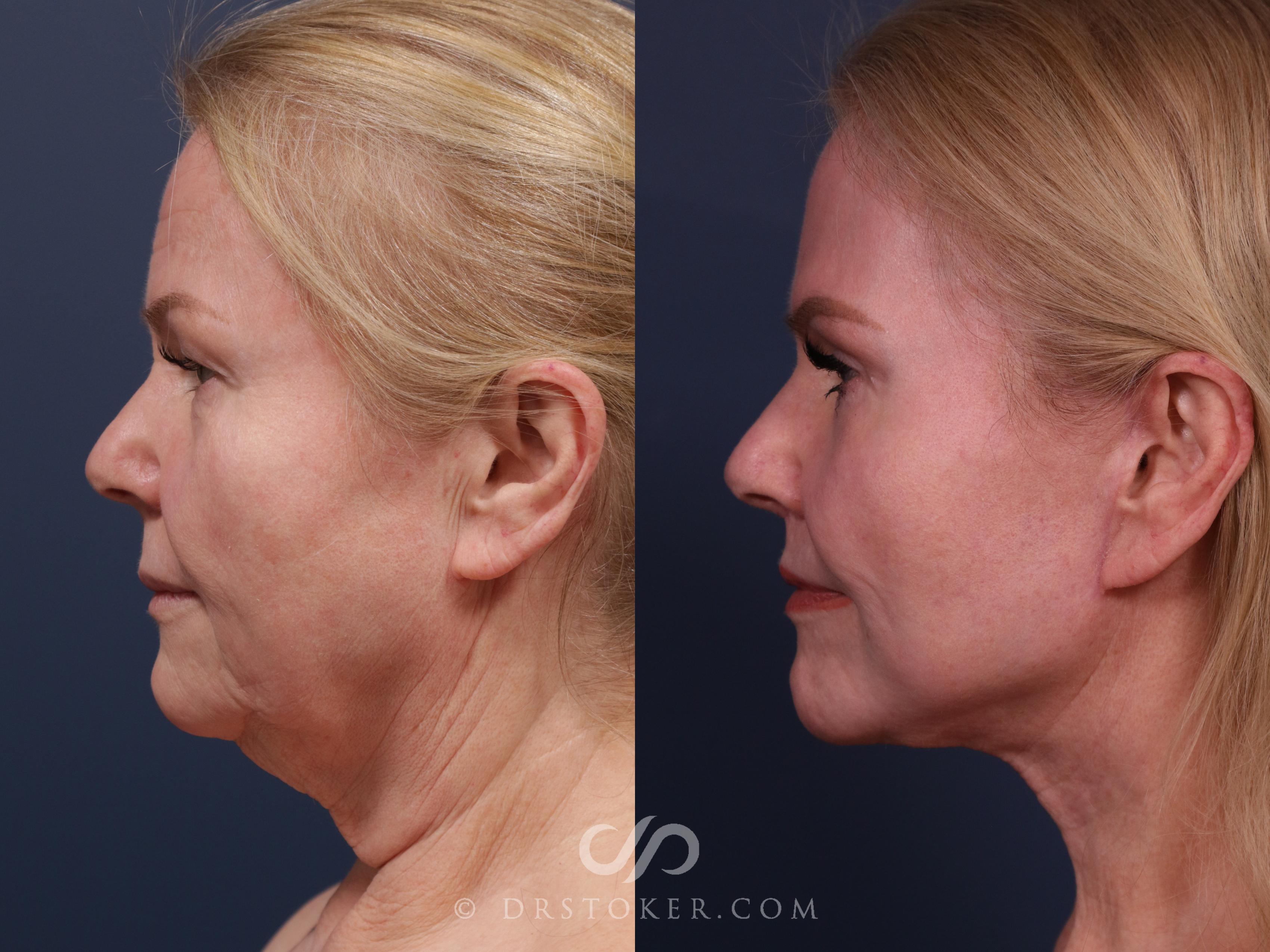 Before & After Facelift - Traceless Facelift Case 2303 Left Side View in Los Angeles, CA