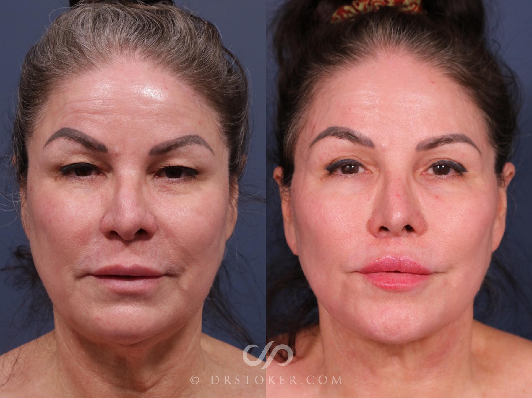 Before & After Facelift - Traceless Facelift Case 2311 Front View in Los Angeles, CA