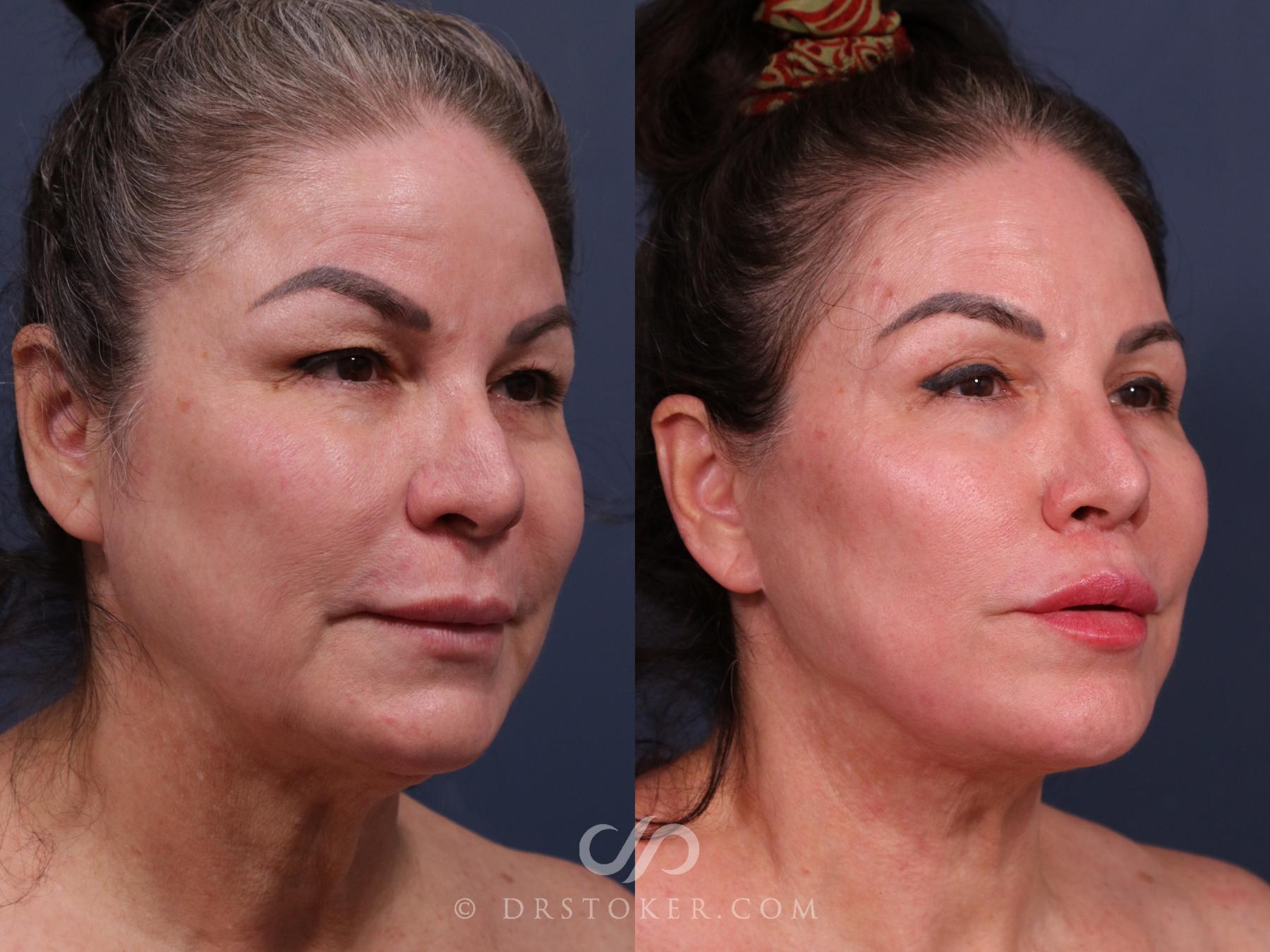 Before & After Facelift - Traceless Facelift Case 2311 Right Oblique View in Los Angeles, CA