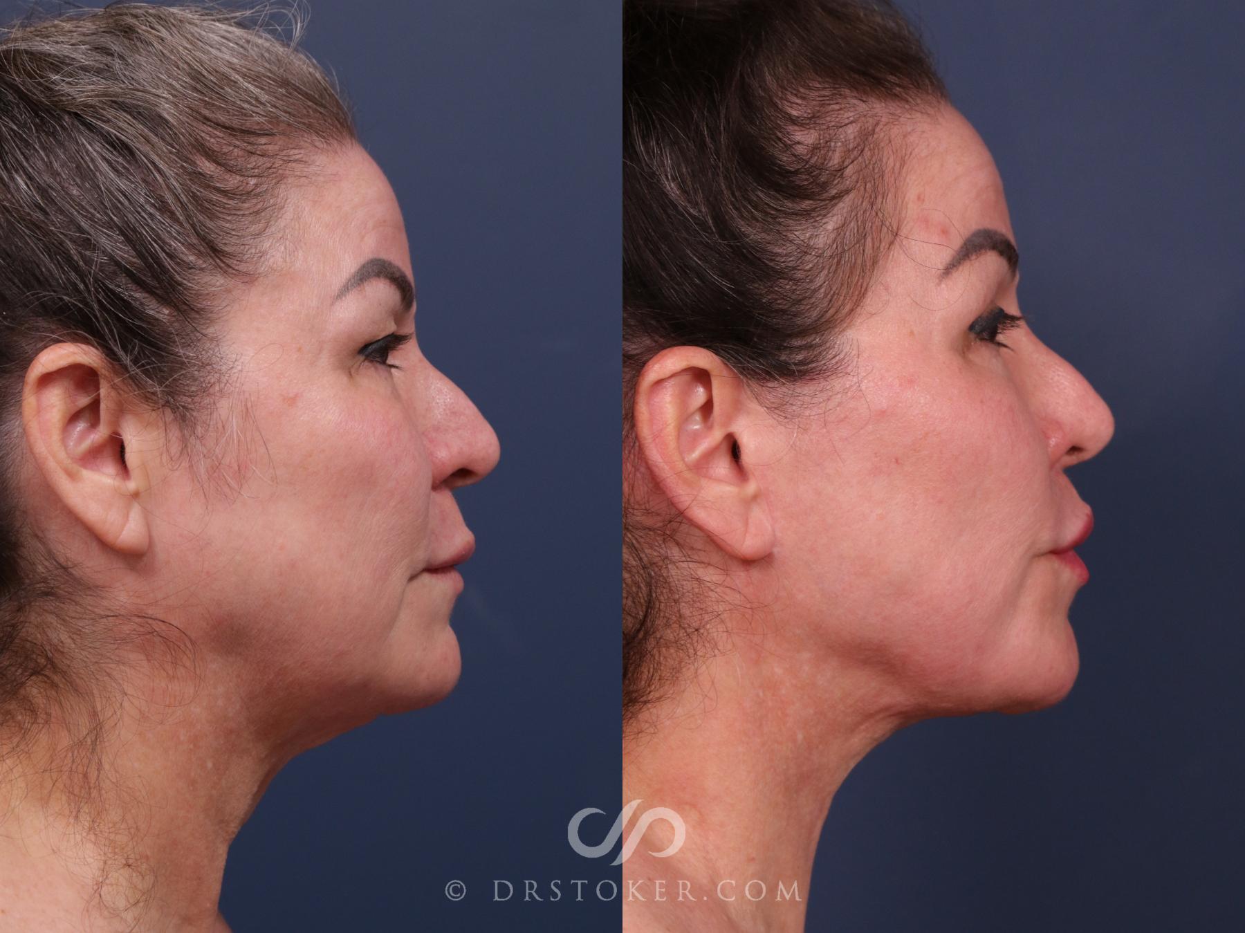 Before & After Facelift - Traceless Facelift Case 2311 Right Side View in Los Angeles, CA