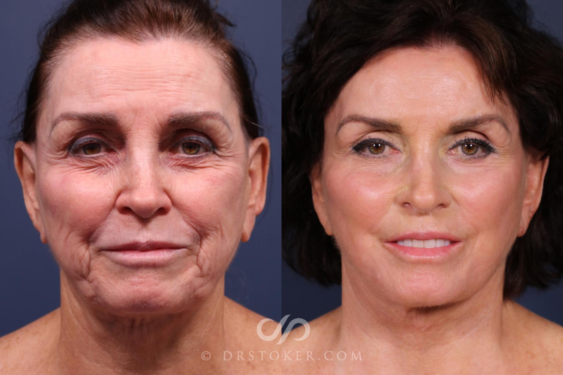 Before & After Facelift - Traceless Facelift Case 2339 Left Side View in Los Angeles, CA