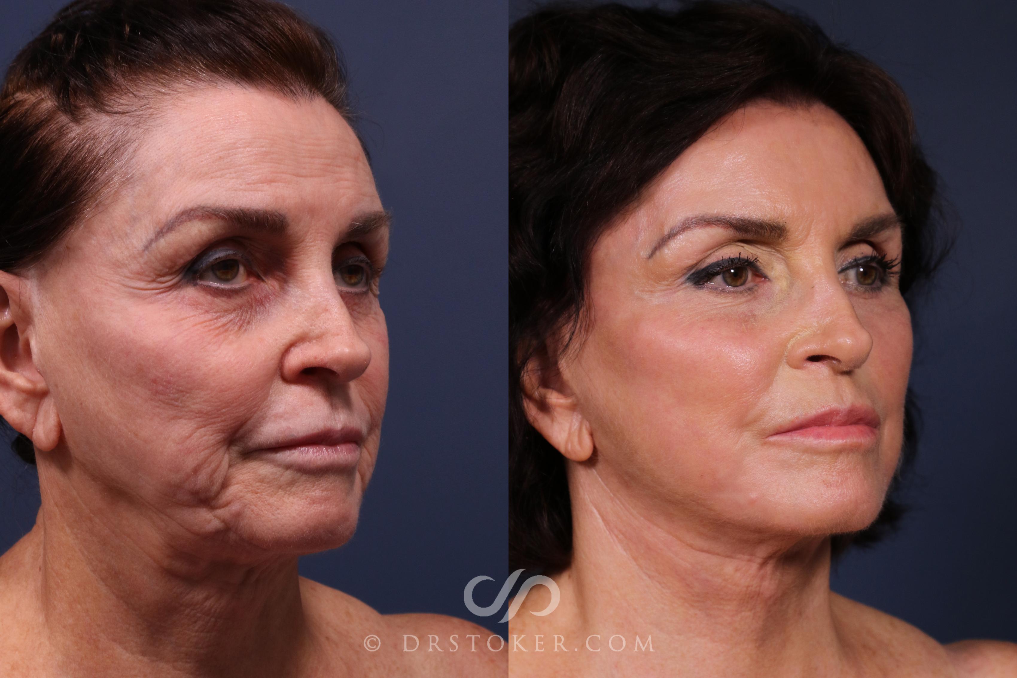 Before & After Facelift - Traceless Facelift Case 2339 Right Oblique View in Los Angeles, CA