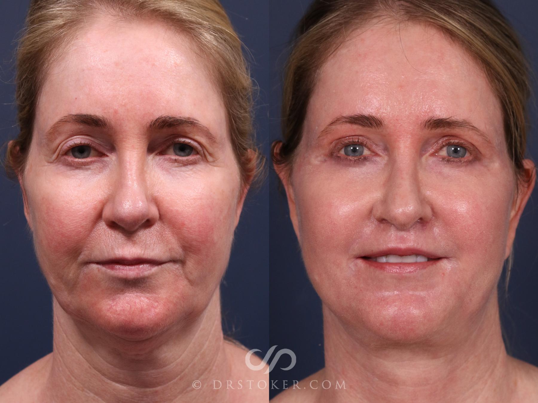 Before & After Facelift - Traceless Facelift Case 2340 Front View in Los Angeles, CA