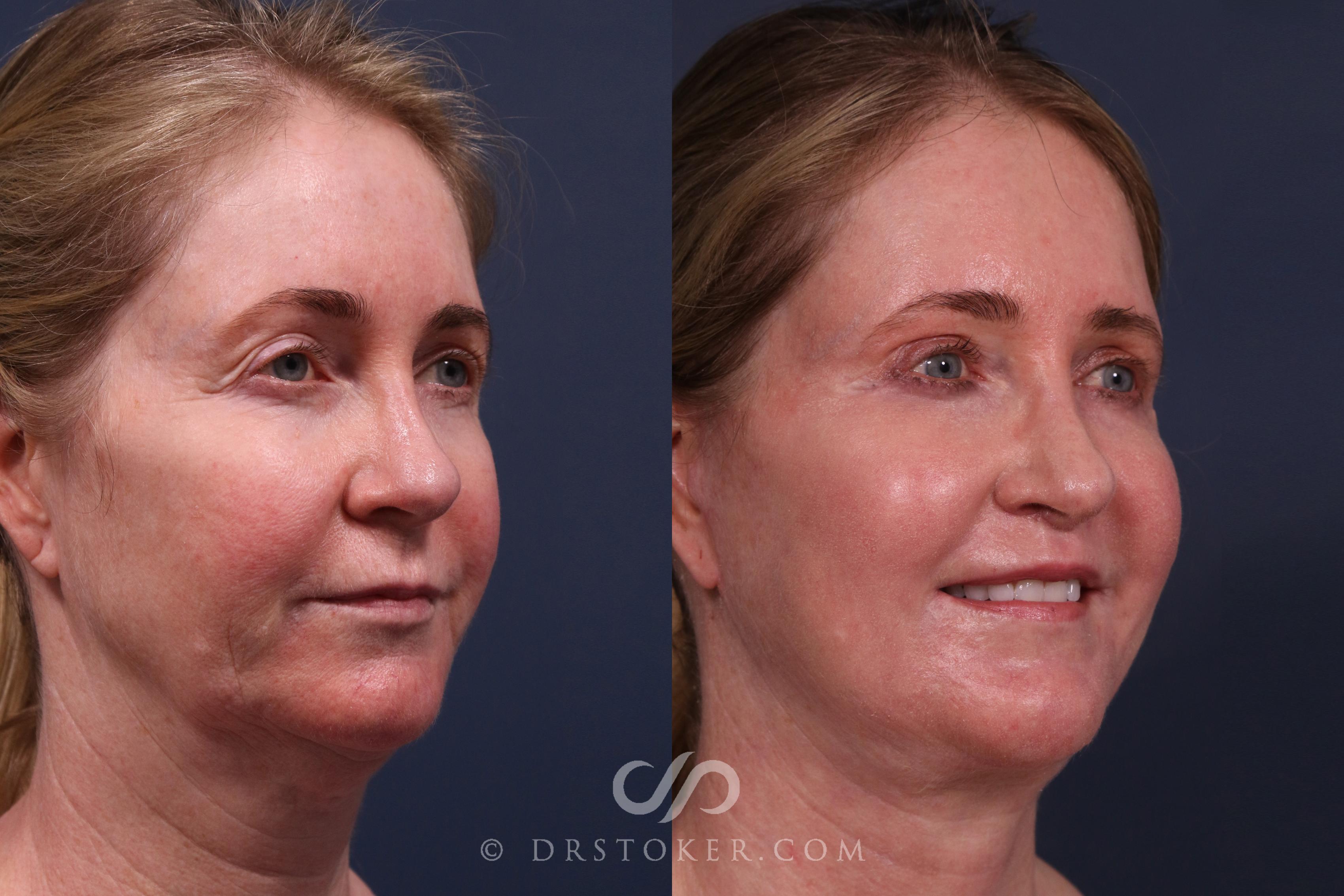 Before & After Facelift - Traceless Facelift Case 2340 Right Oblique View in Los Angeles, CA