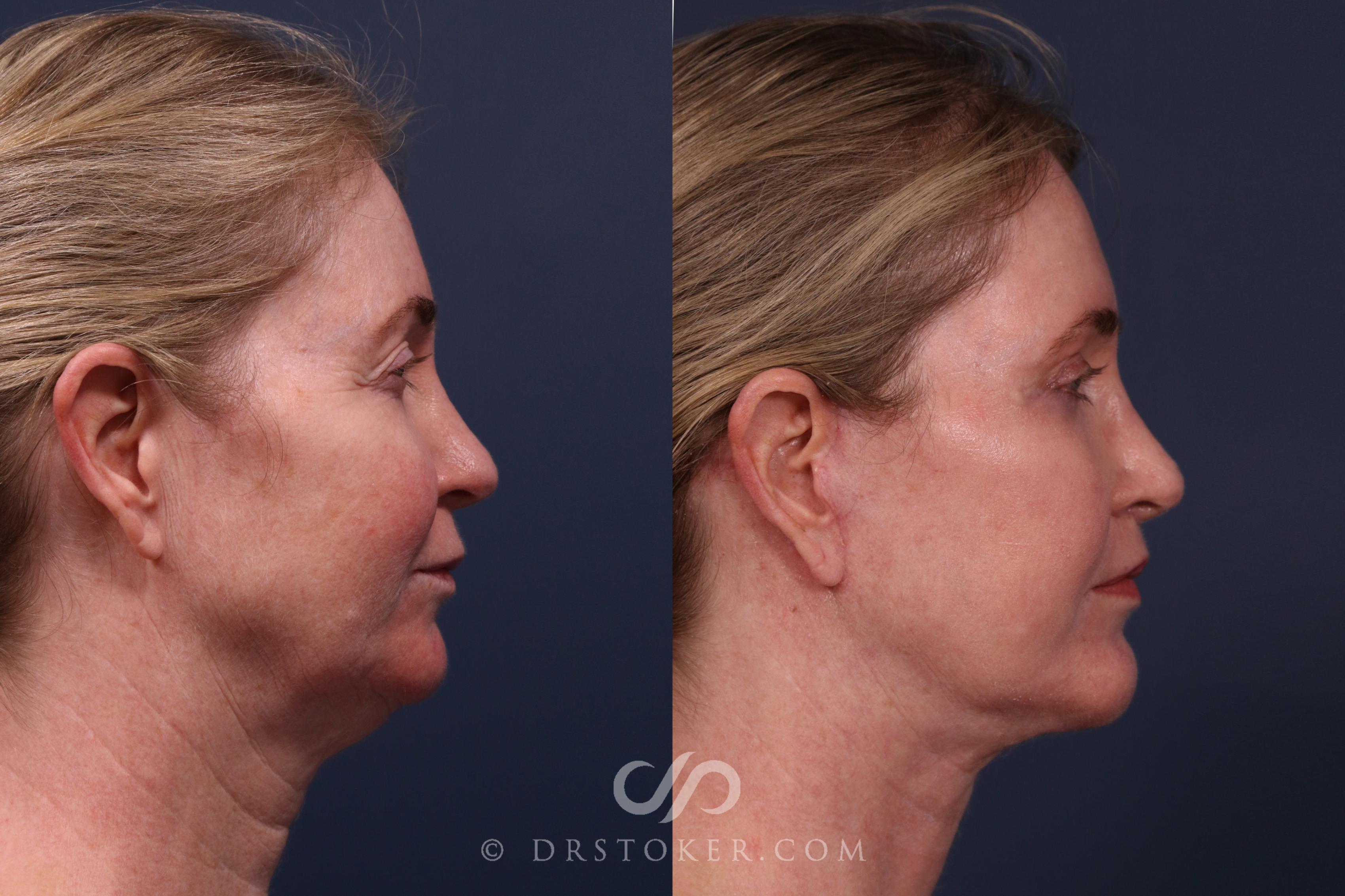 Before & After Facelift - Traceless Facelift Case 2340 Right Side View in Los Angeles, CA