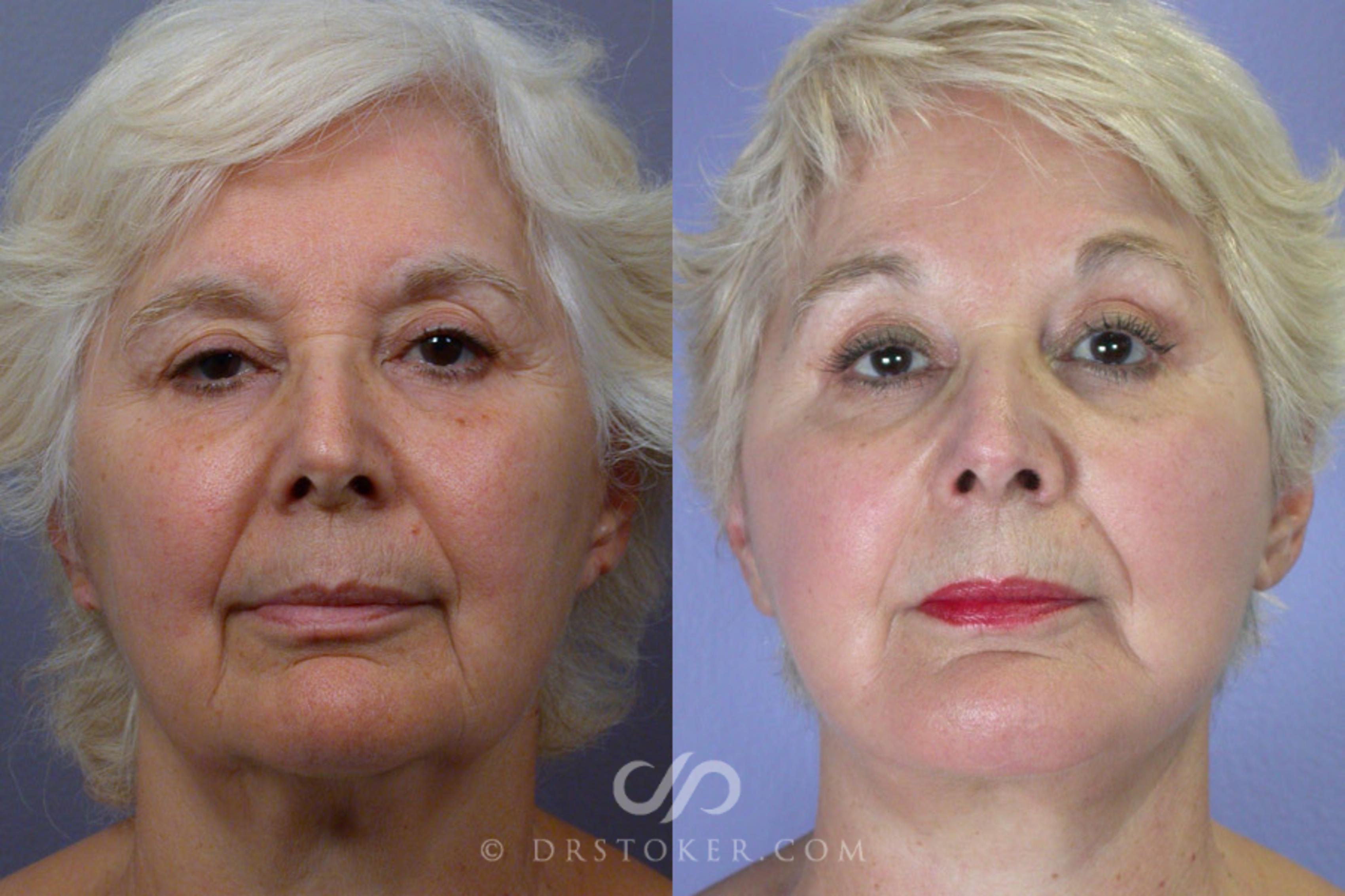 Before & After Facelift - Traceless Facelift Case 251 View #1 View in Los Angeles, CA