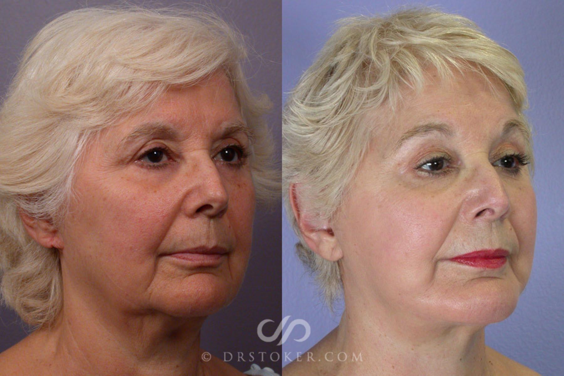 Before & After Facelift - Traceless Facelift Case 251 View #2 View in Los Angeles, CA