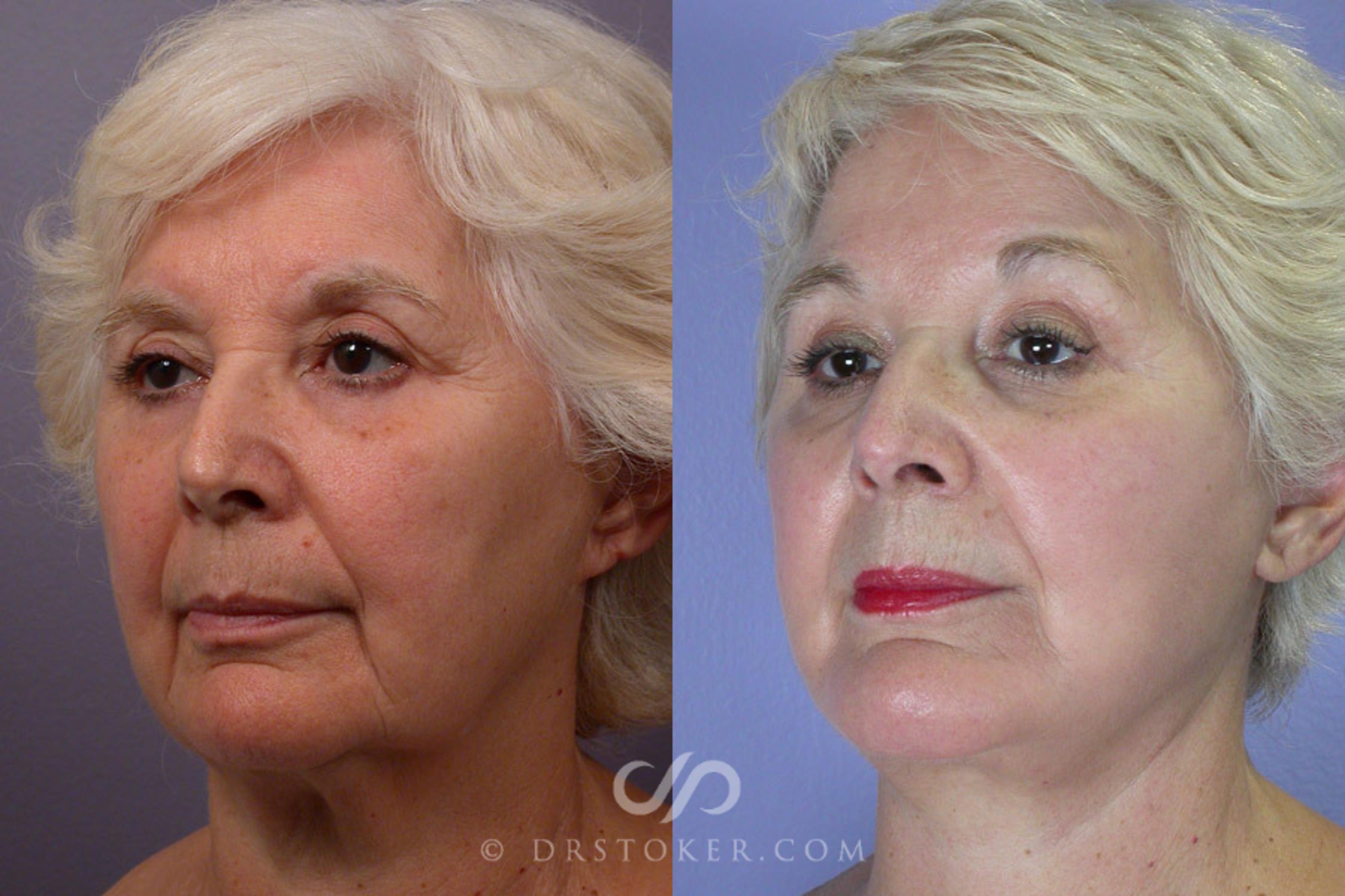 Before & After Facelift - Traceless Facelift Case 251 View #3 View in Los Angeles, CA