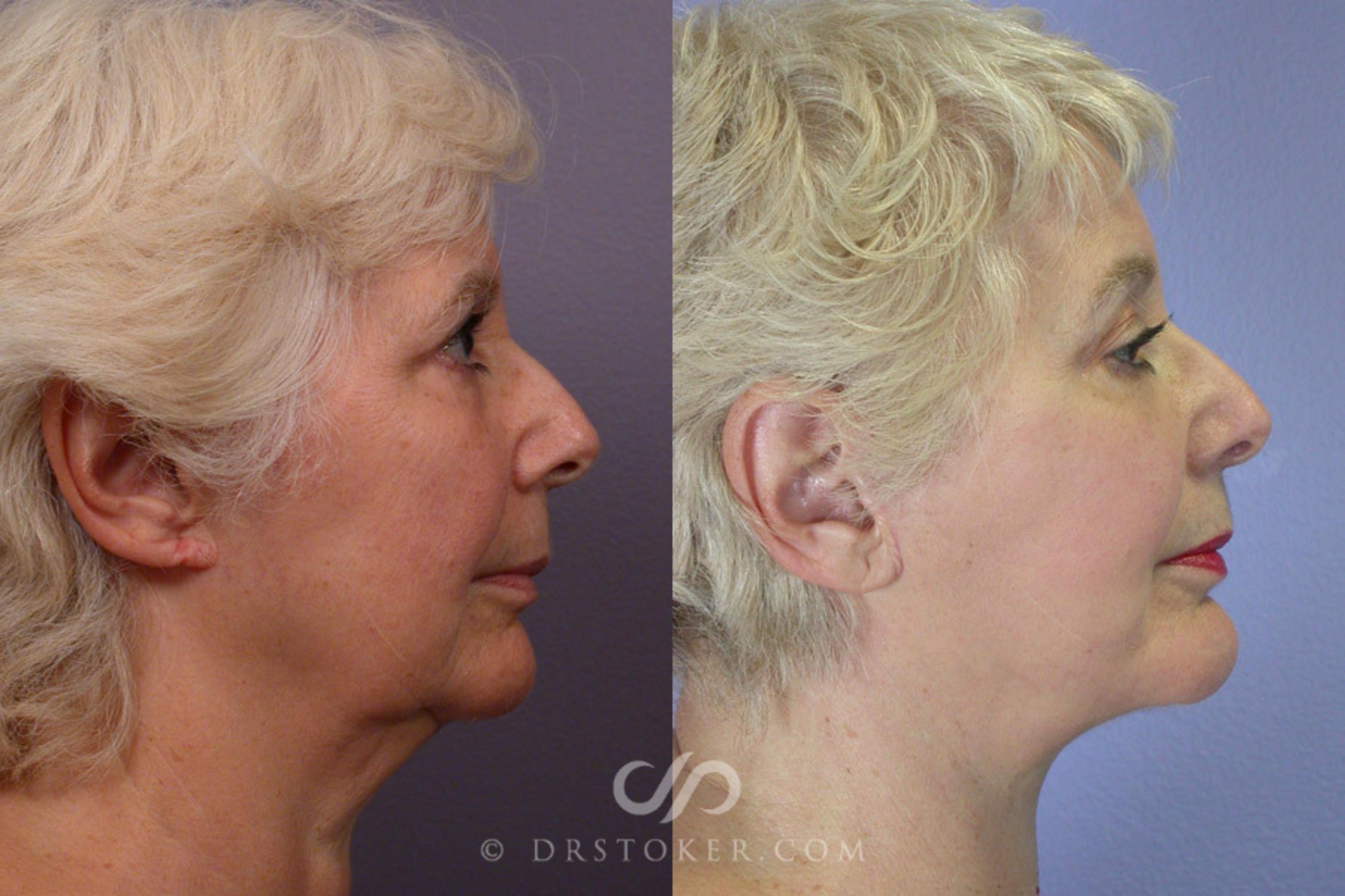 Before & After Facelift - Traceless Facelift Case 251 View #4 View in Los Angeles, CA