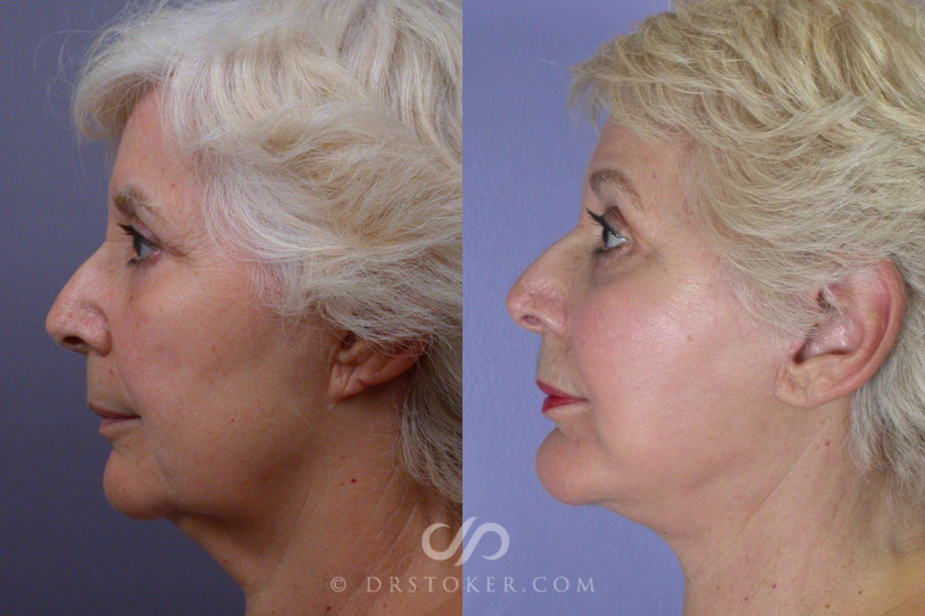 Before & After Facelift - Traceless Facelift Case 251 View #5 View in Los Angeles, CA
