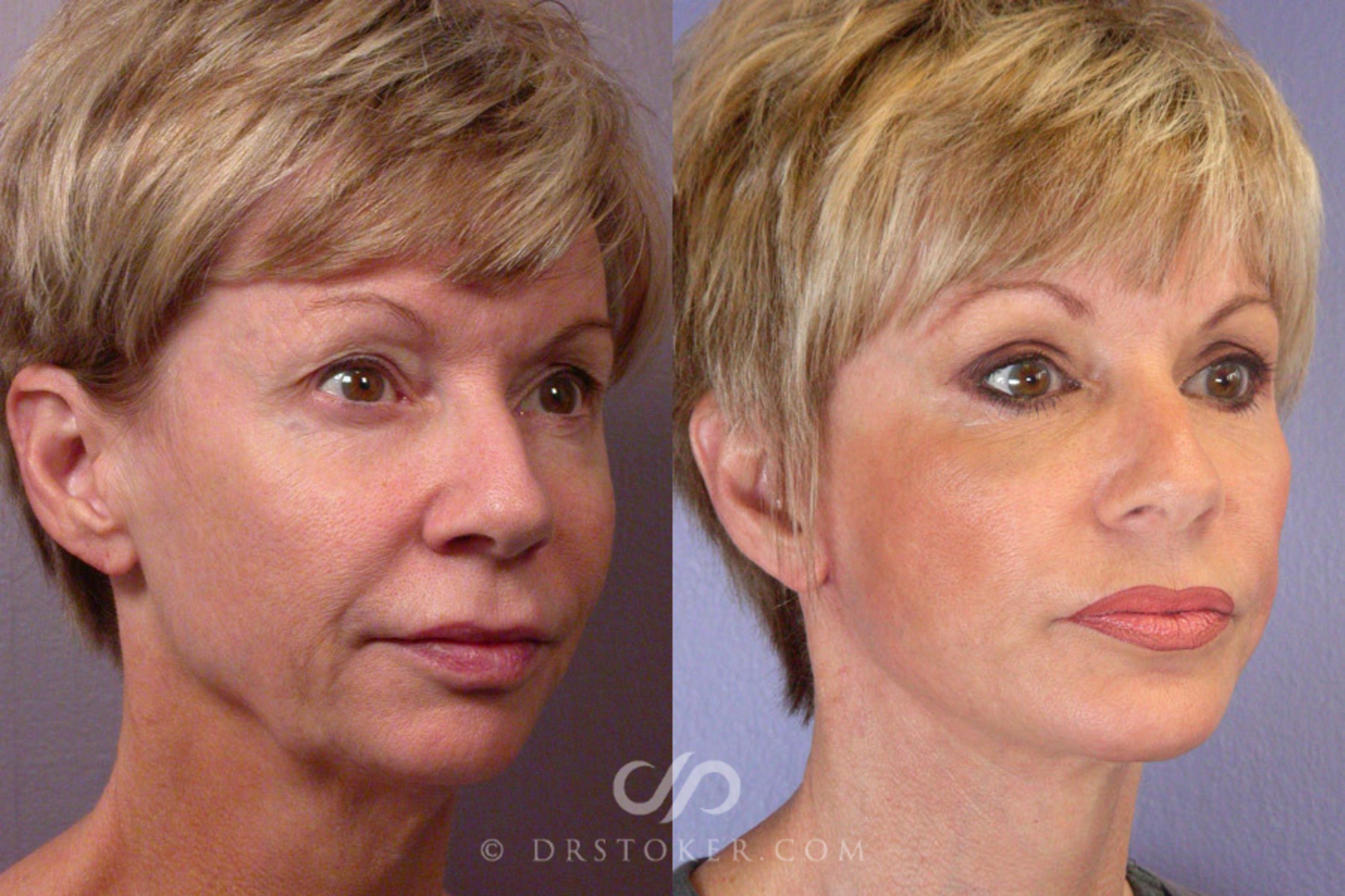 Before & After Facelift - Traceless Facelift Case 252 View #1 View in Los Angeles, CA