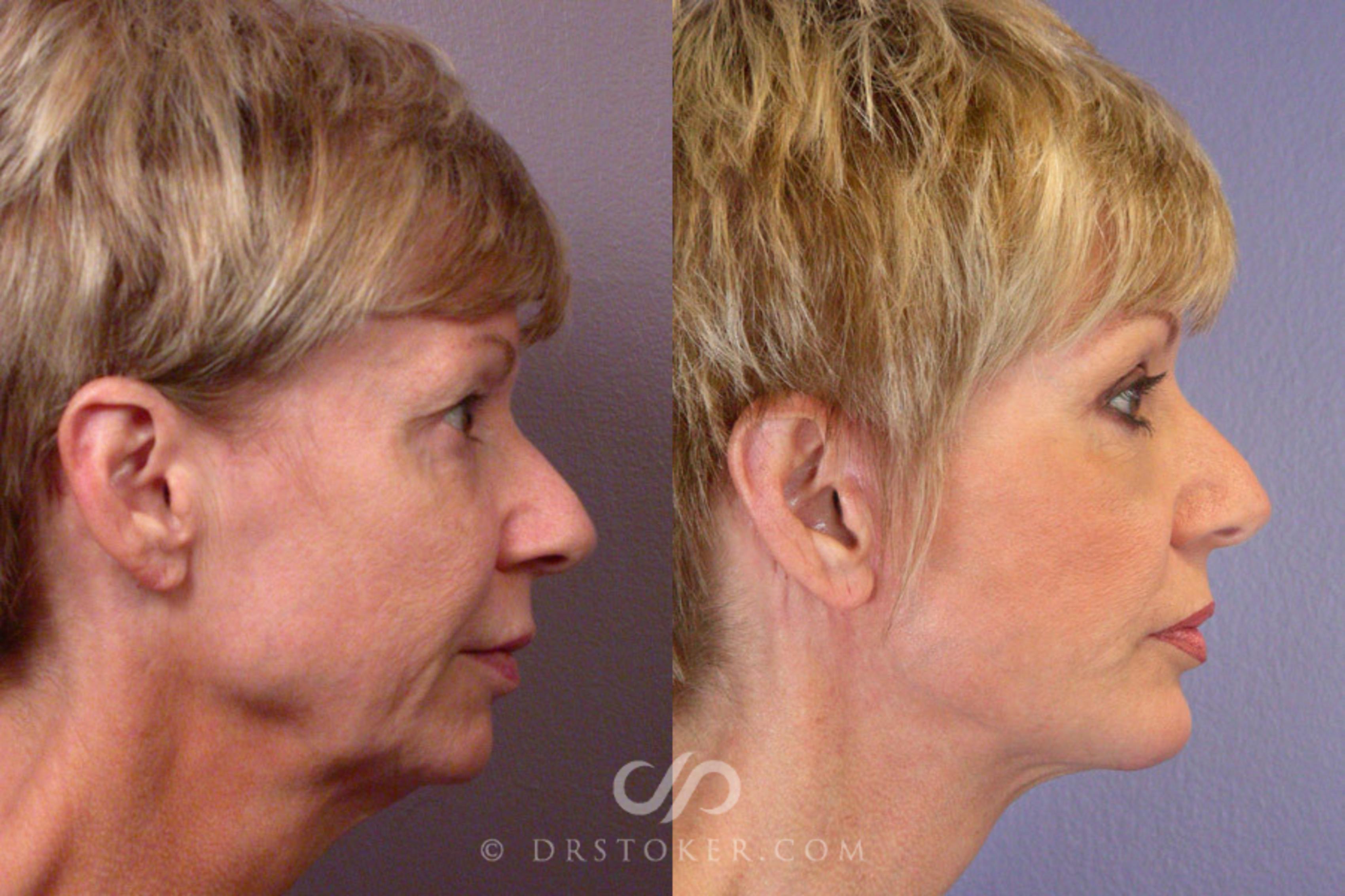 Before & After Facelift - Traceless Facelift Case 252 View #2 View in Los Angeles, CA