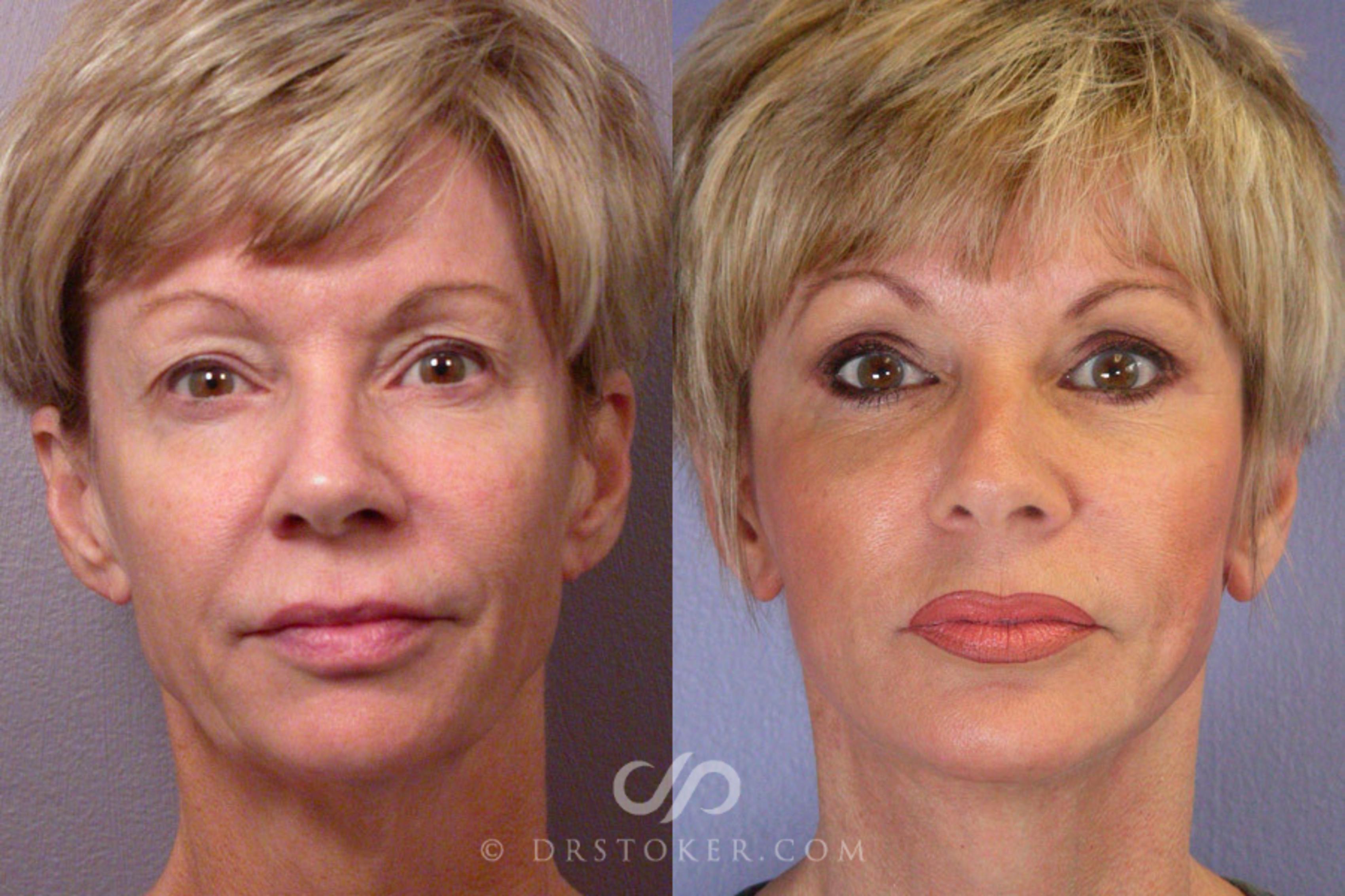 Before & After Facelift - Traceless Facelift Case 252 View #3 View in Los Angeles, CA