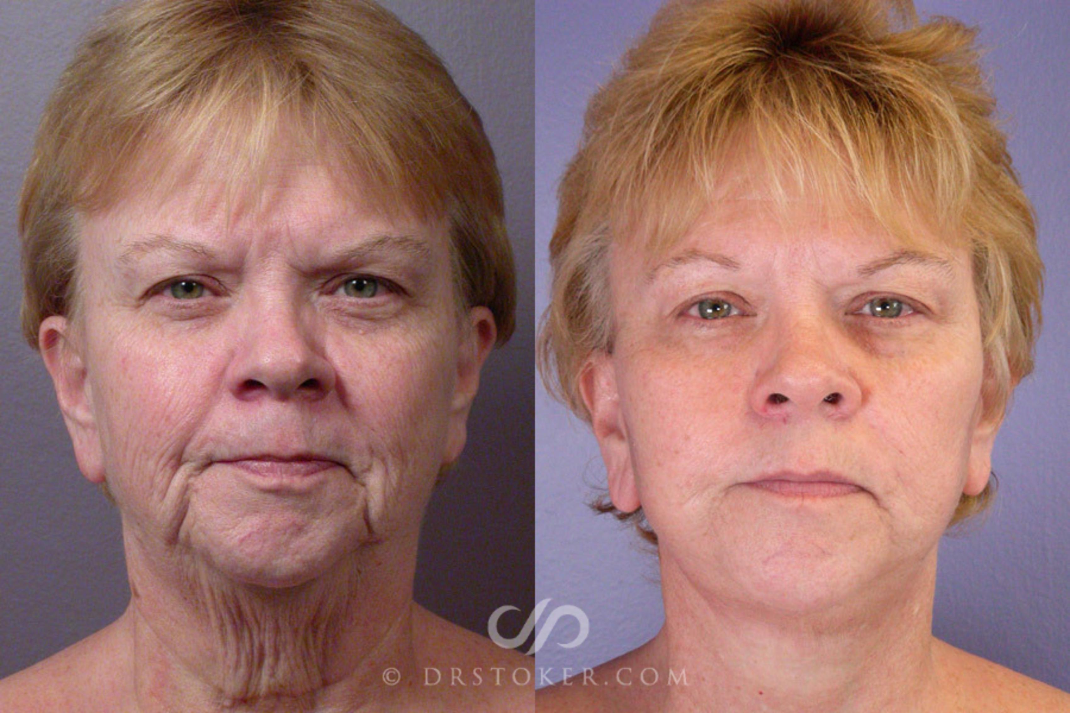 Before & After Neck Lift - Traceless Neck Lift  Case 253 View #1 View in Los Angeles, CA