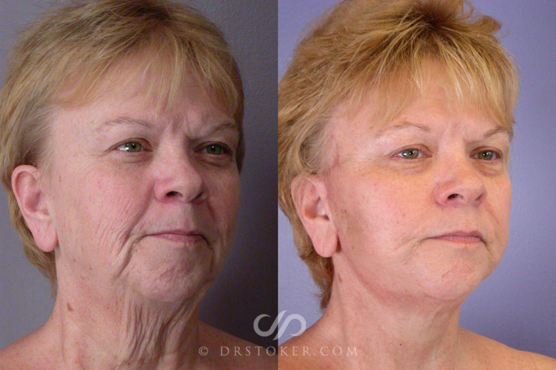 Before & After Facelift - Traceless Facelift Case 253 View #2 View in Los Angeles, CA