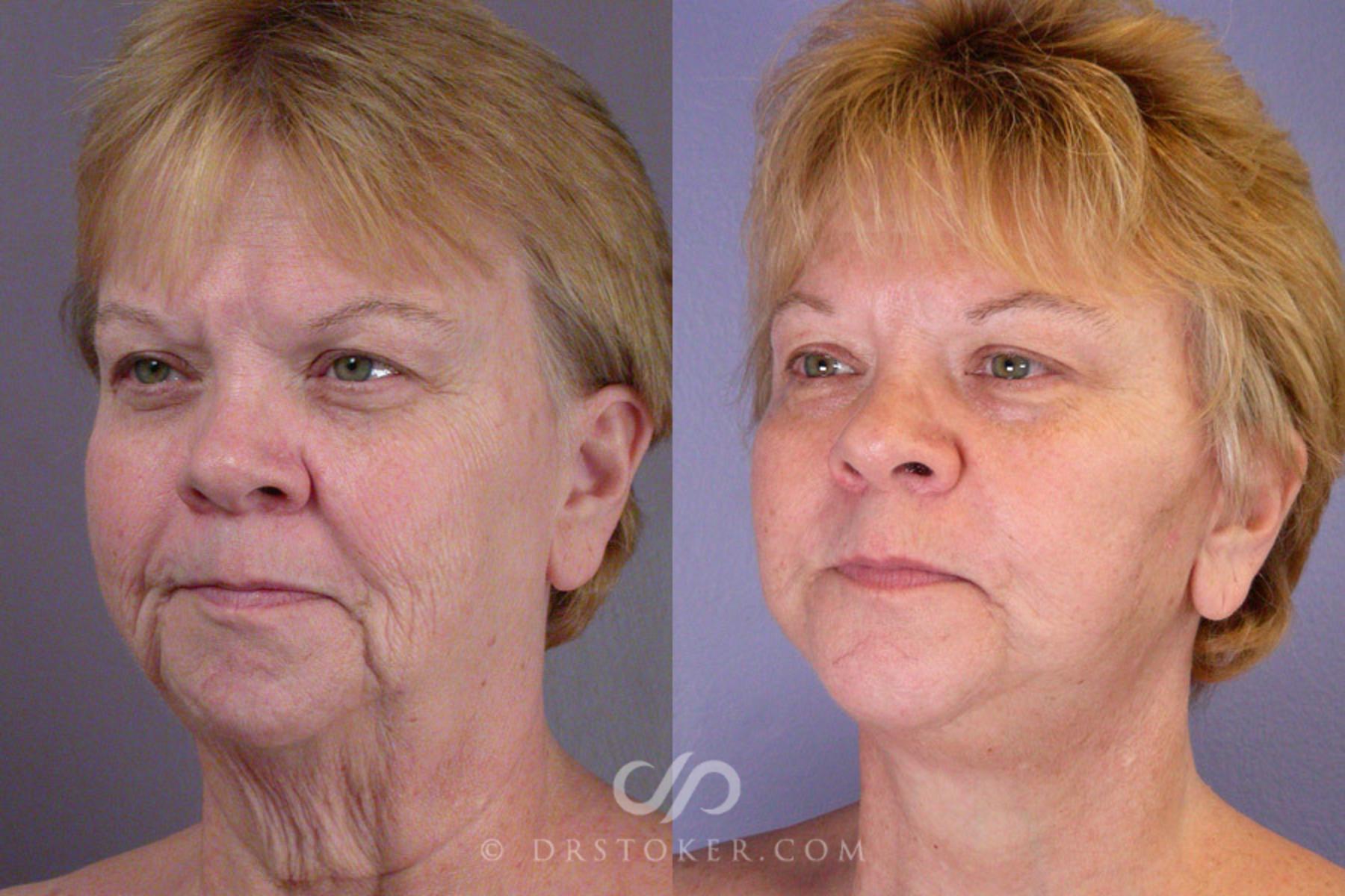 Before & After Facelift - Traceless Facelift Case 253 View #3 View in Los Angeles, CA