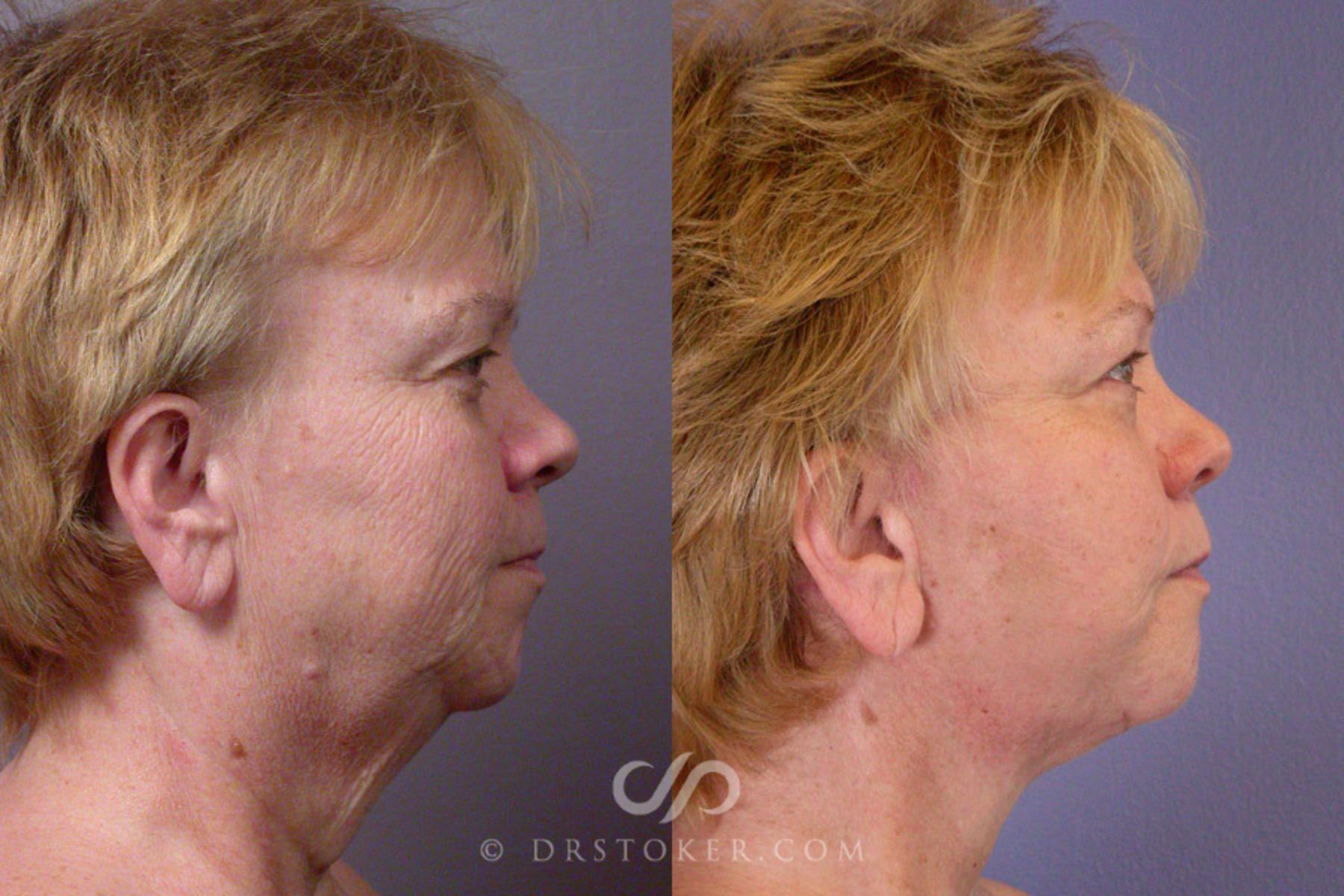 Before & After Neck Lift - Traceless Neck Lift  Case 253 View #4 View in Los Angeles, CA