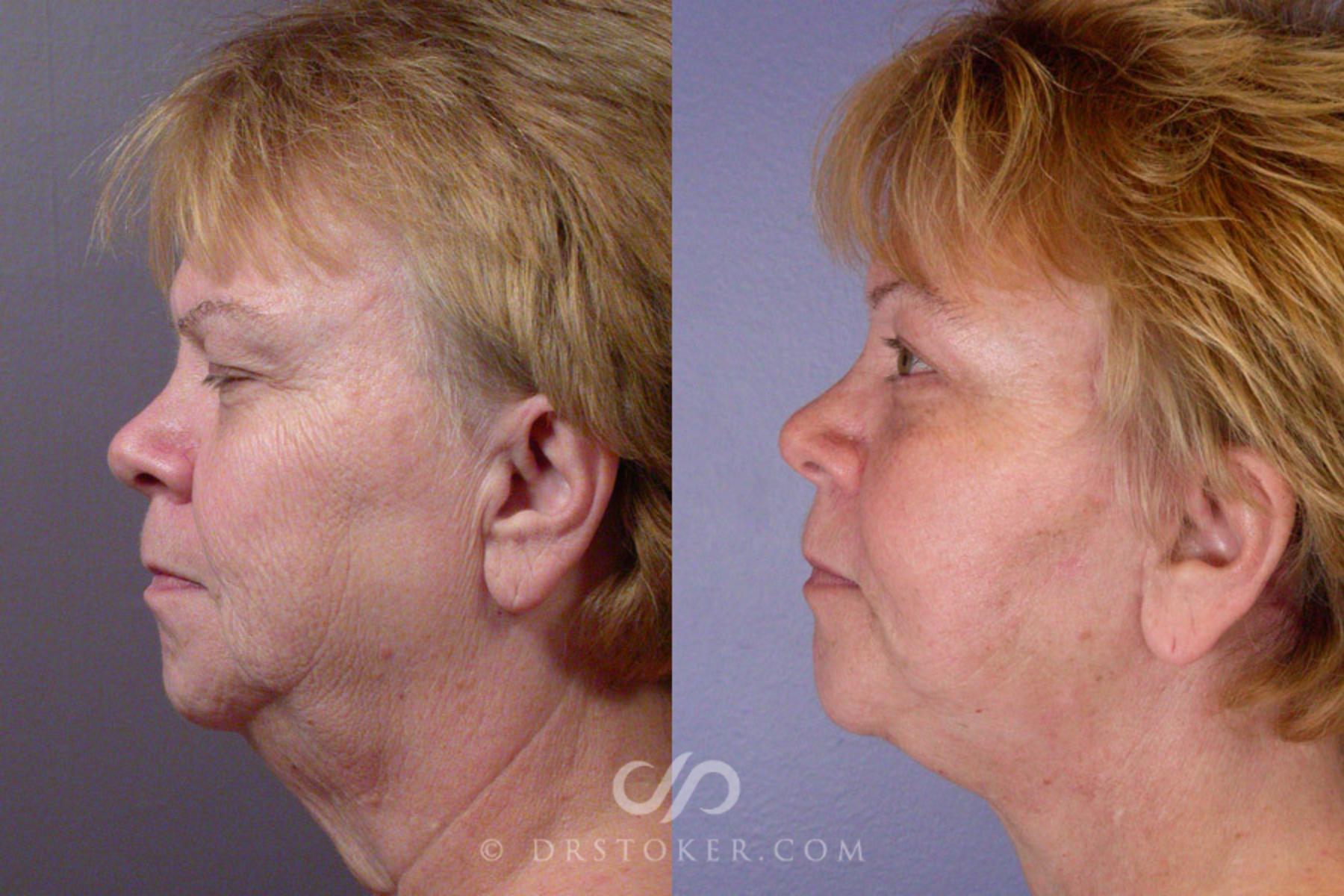 Before & After Neck Lift - Traceless Neck Lift  Case 253 View #5 View in Los Angeles, CA