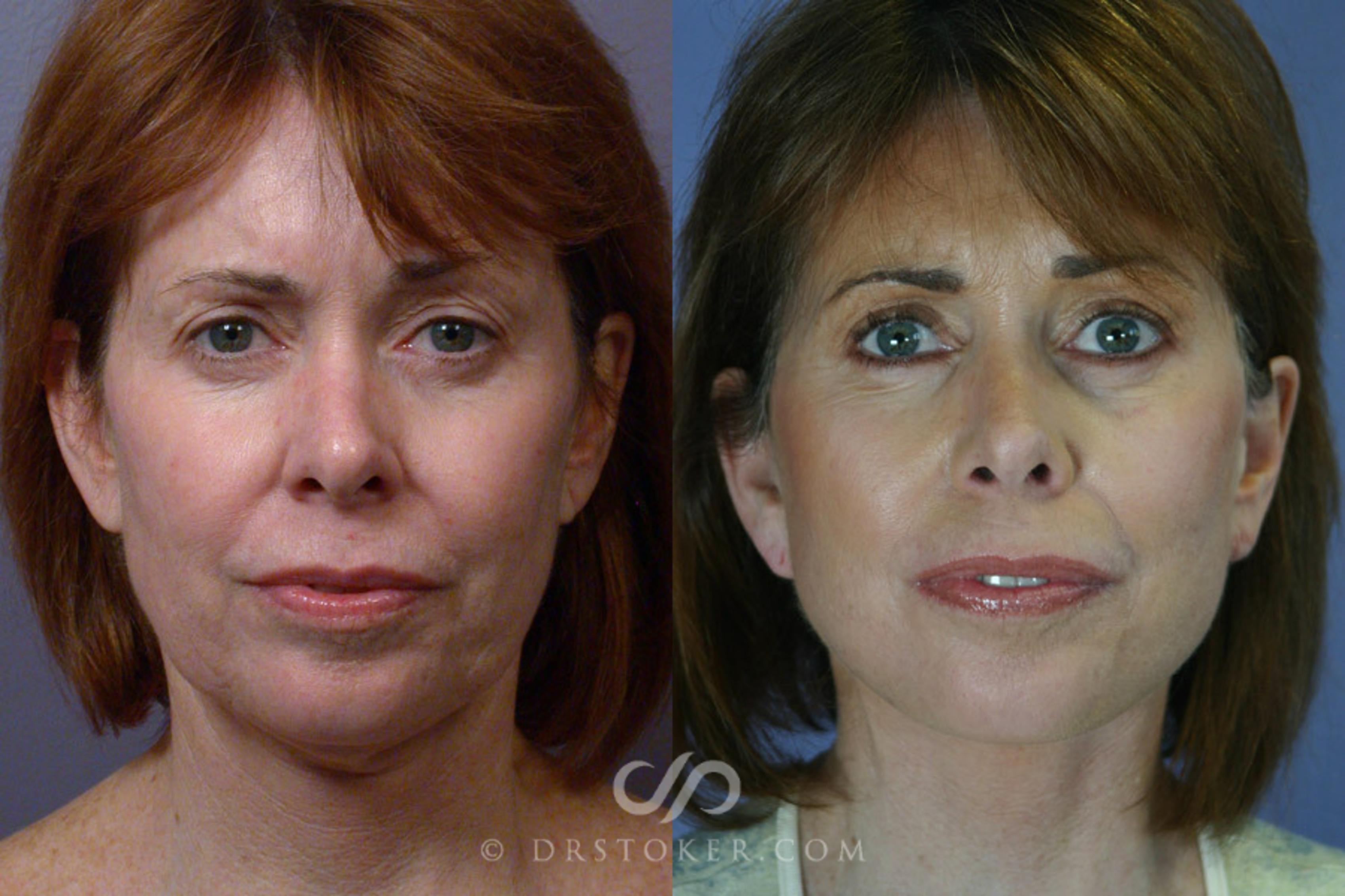 Before & After Facelift - Traceless Facelift Case 254 View #1 View in Los Angeles, CA