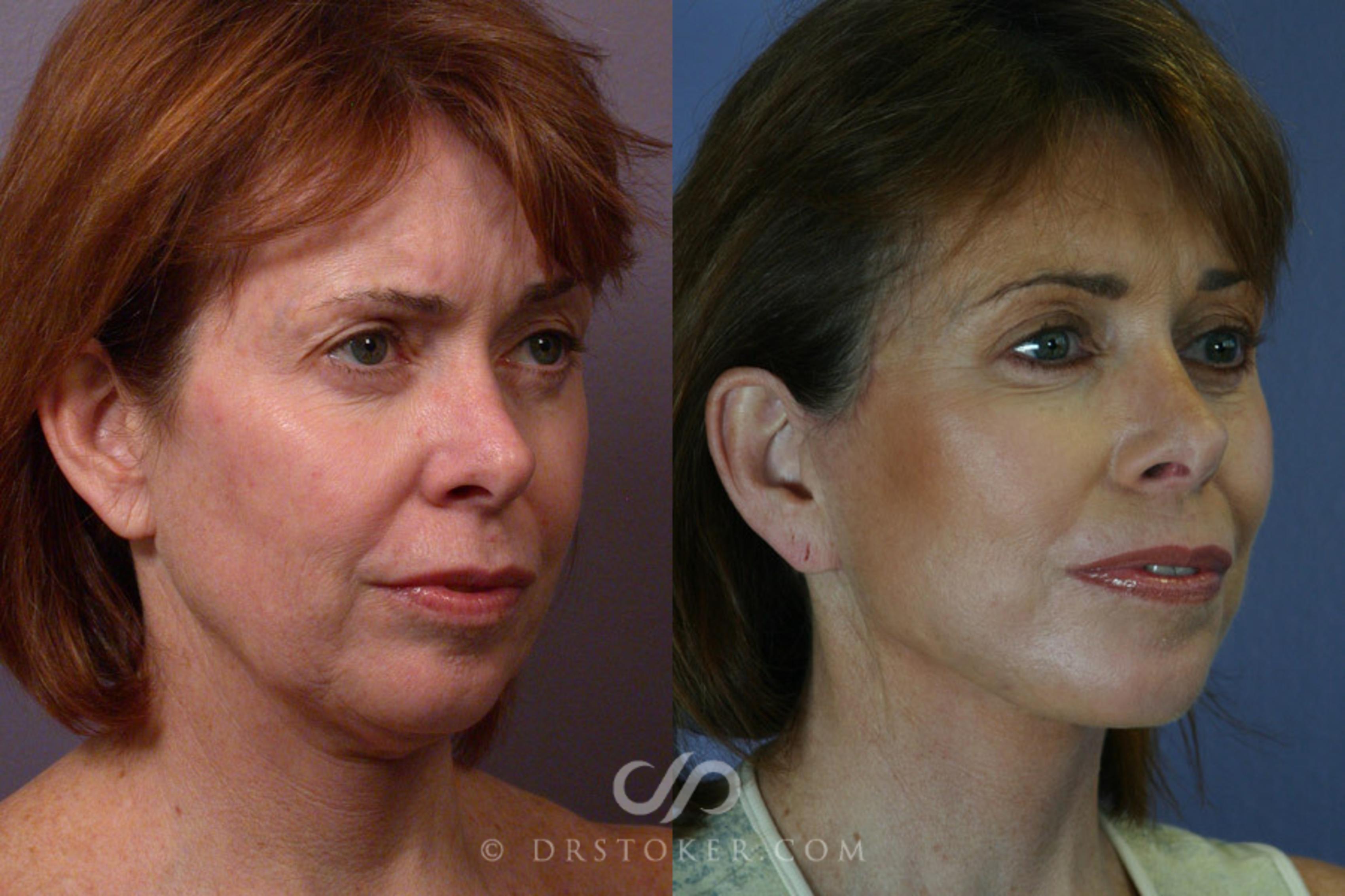 Before & After Facelift - Traceless Facelift Case 254 View #2 View in Los Angeles, CA