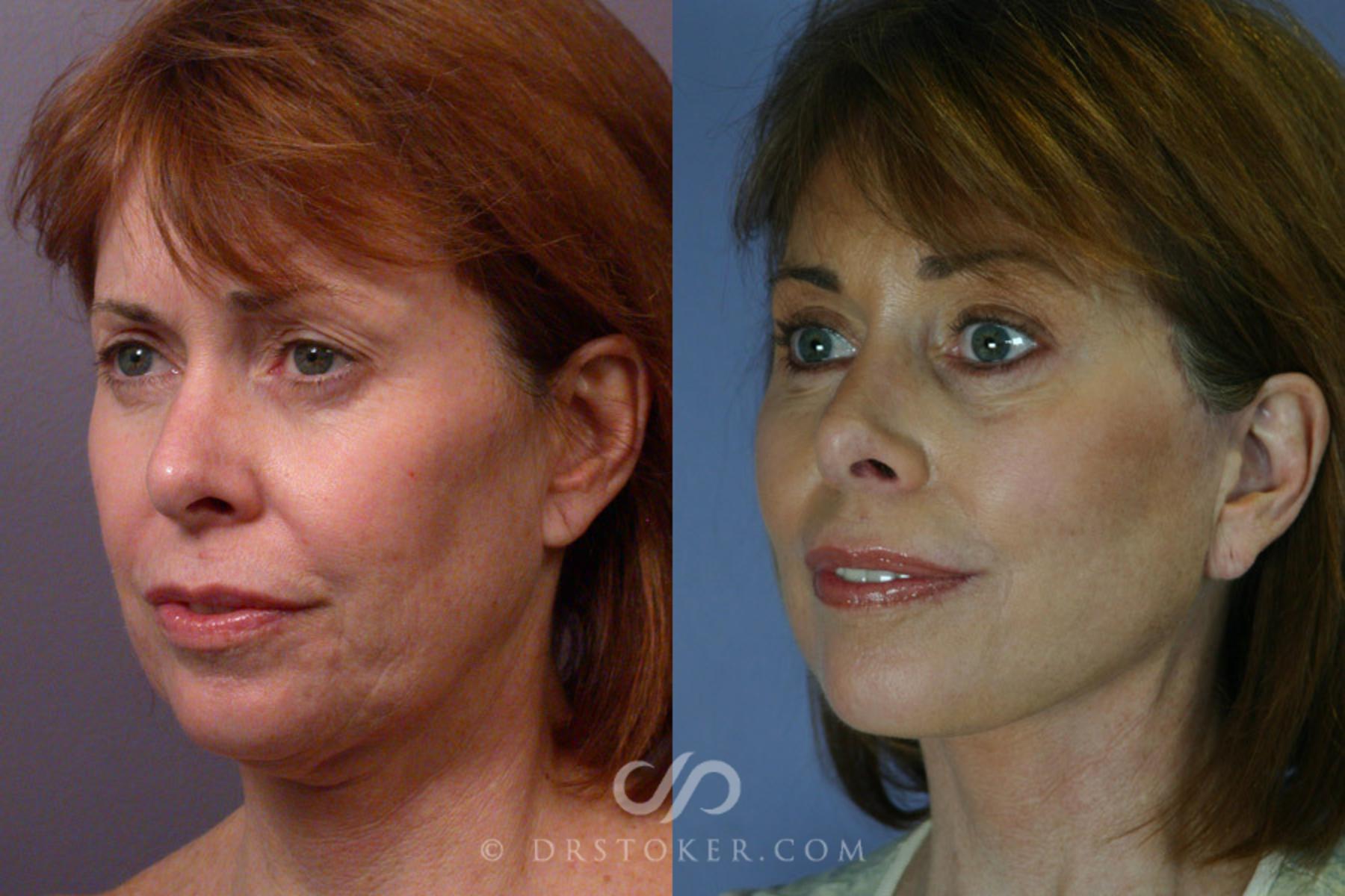 Before & After Facelift - Traceless Facelift Case 254 View #3 View in Los Angeles, CA