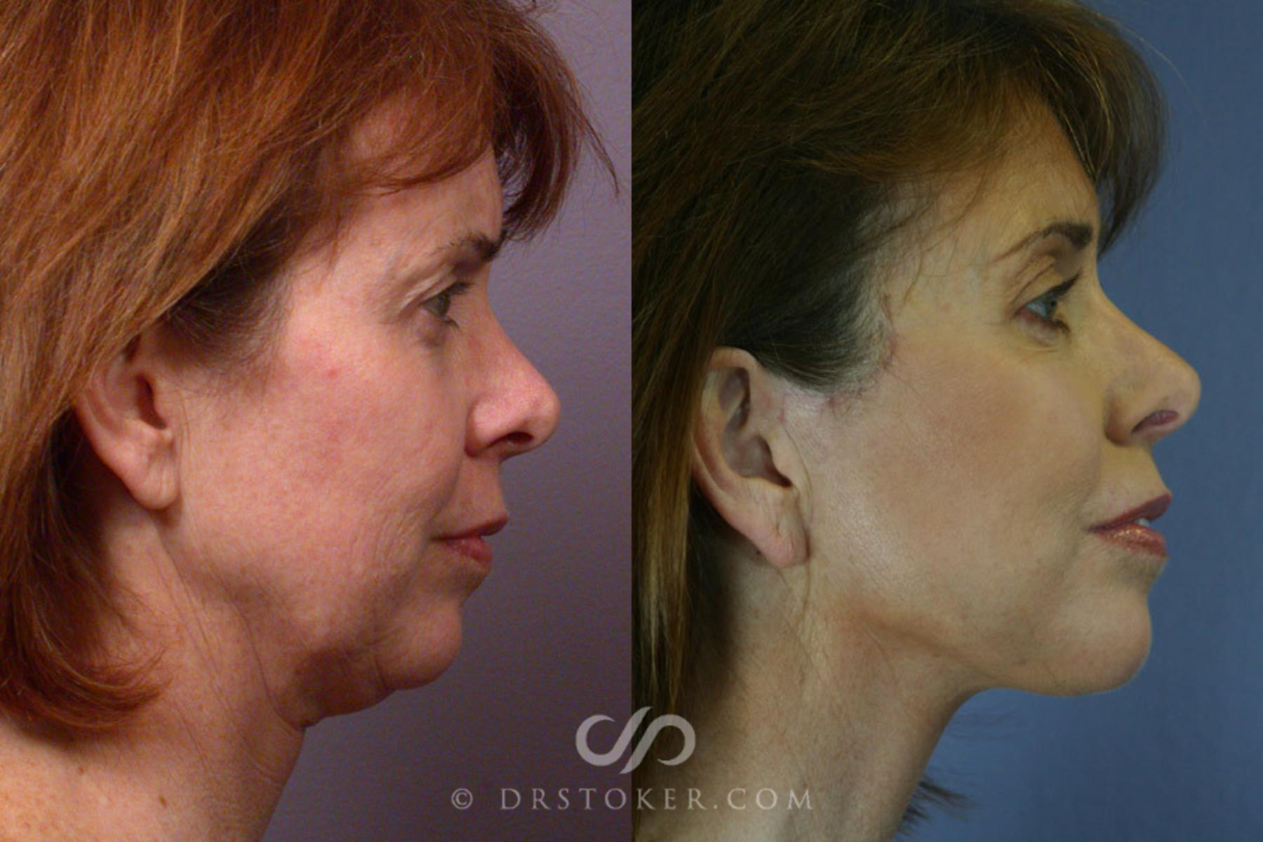 Before & After Facelift - Traceless Facelift Case 254 View #4 View in Los Angeles, CA