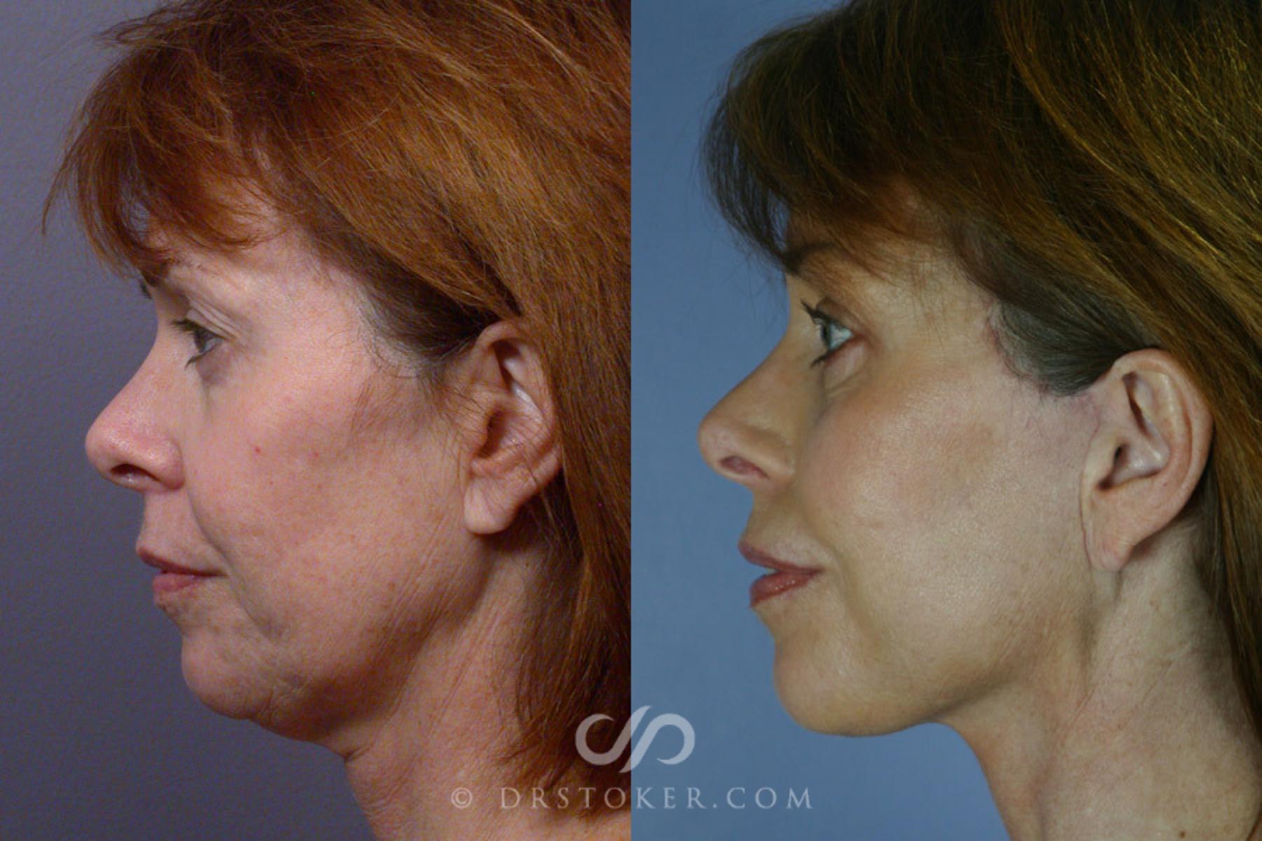 Before & After Facelift - Traceless Facelift Case 254 View #5 View in Los Angeles, CA