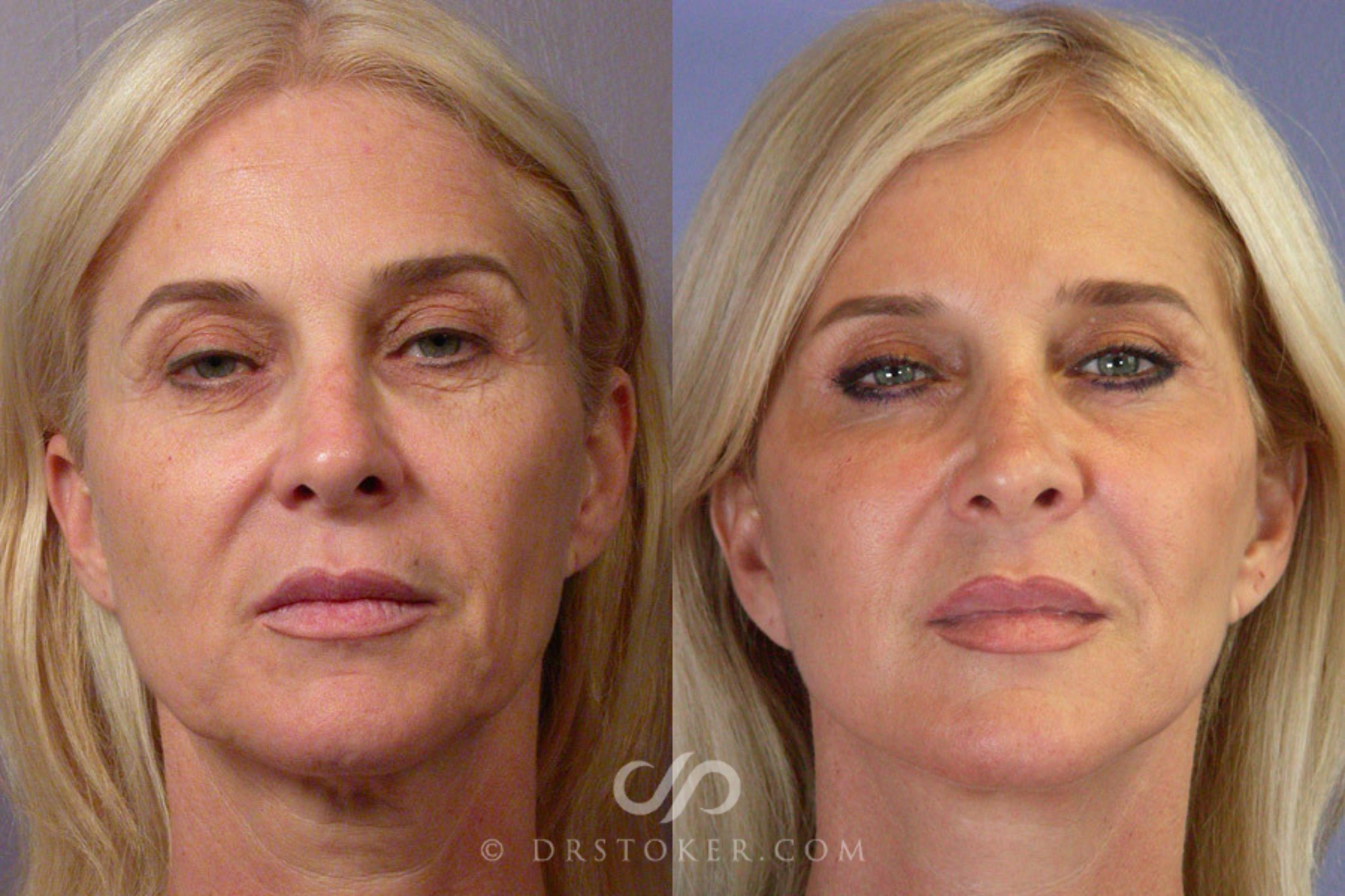 Before & After Facelift - Traceless Facelift Case 255 View #1 View in Los Angeles, CA