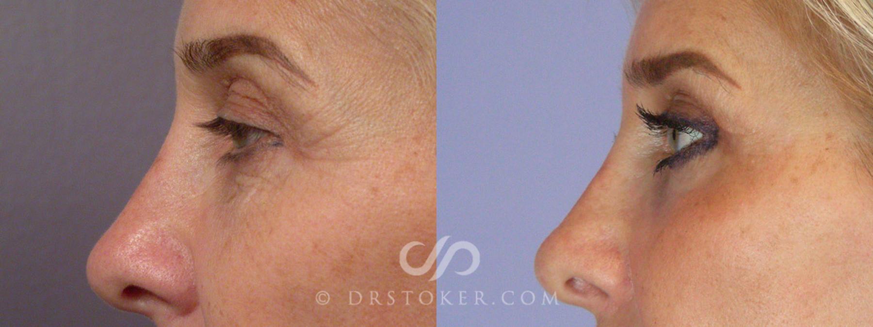 Before & After Neck Lift - Traceless Neck Lift  Case 255 View #10 View in Los Angeles, CA