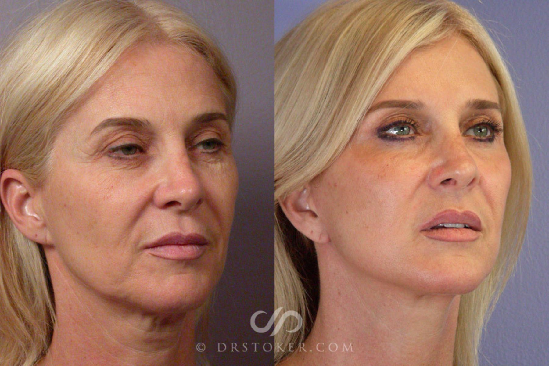 Before & After Neck Lift - Traceless Neck Lift  Case 255 View #2 View in Los Angeles, CA