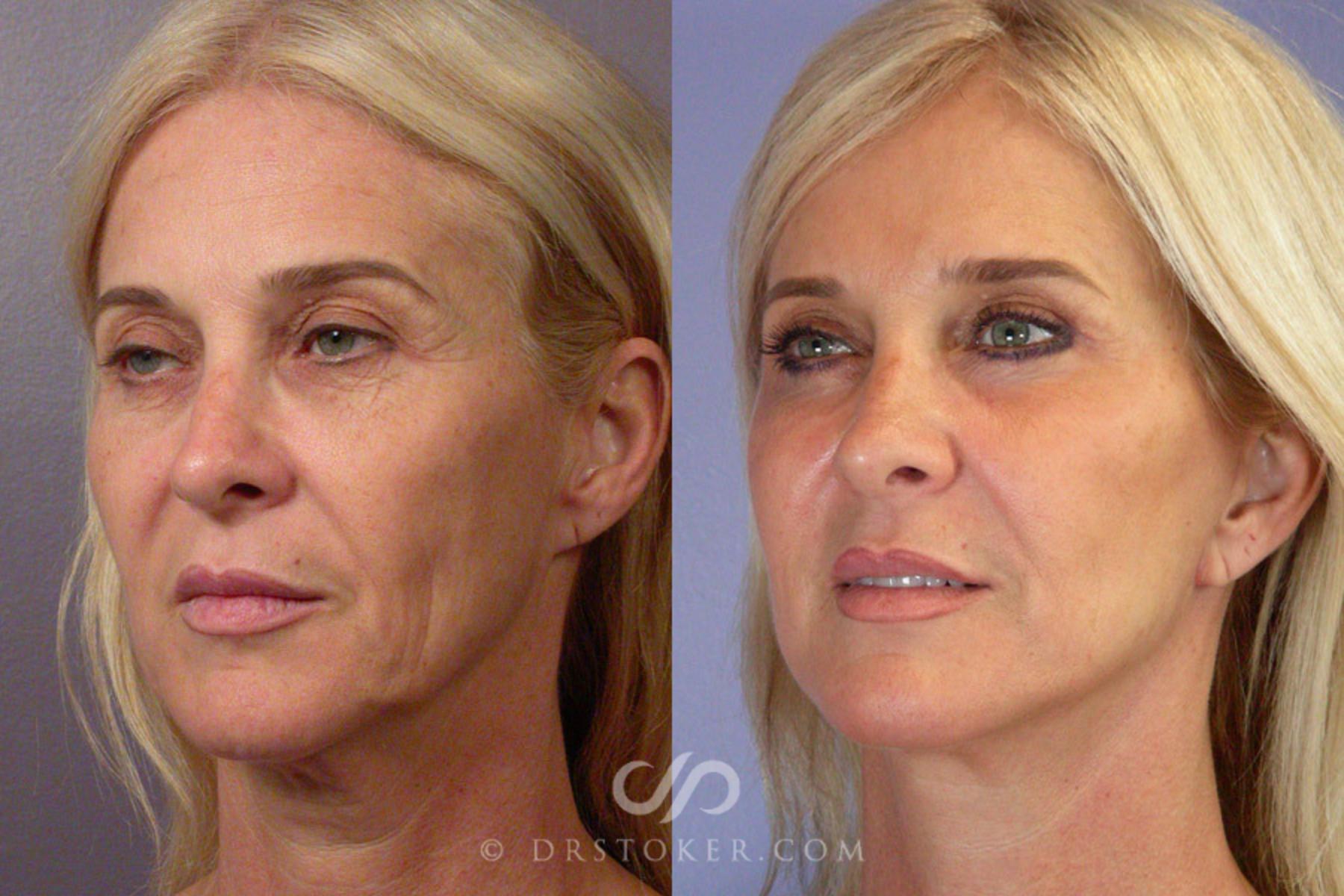 Before & After Facelift - Traceless Facelift Case 255 View #3 View in Los Angeles, CA