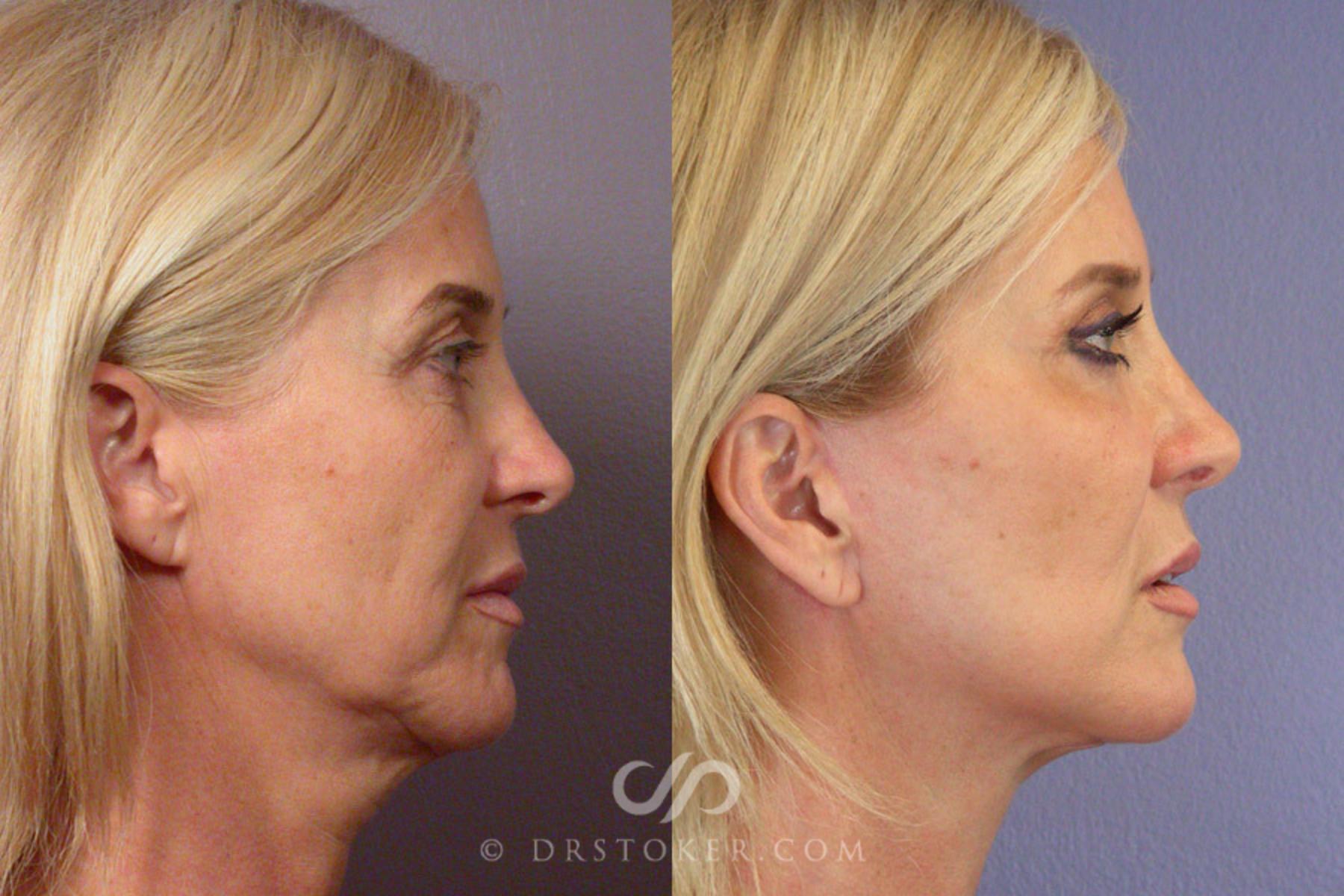 Before & After Neck Lift - Traceless Neck Lift  Case 255 View #4 View in Los Angeles, CA