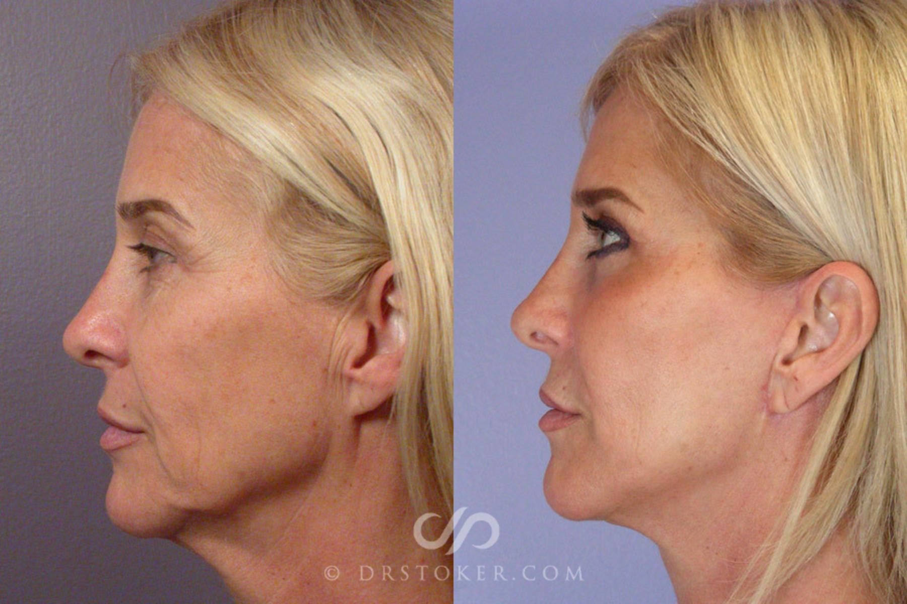 Before & After Facelift - Traceless Facelift Case 255 View #5 View in Los Angeles, CA