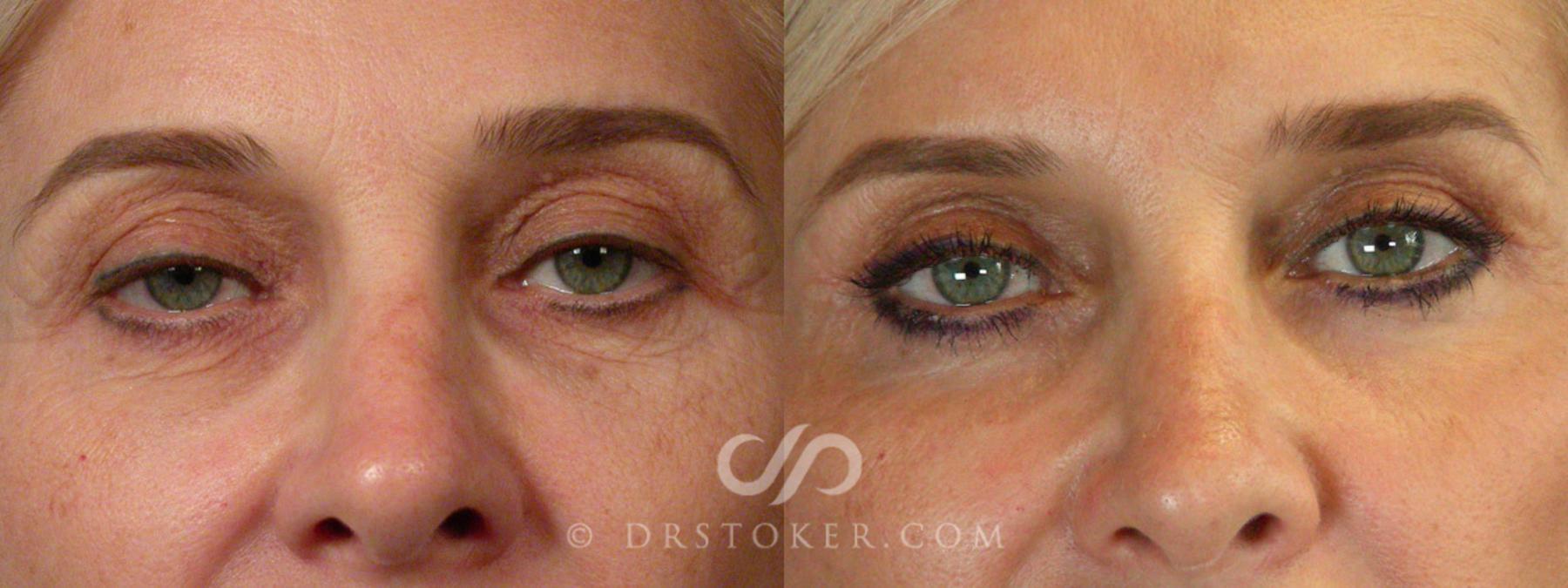 Before & After Facelift - Traceless Facelift Case 255 View #6 View in Los Angeles, CA