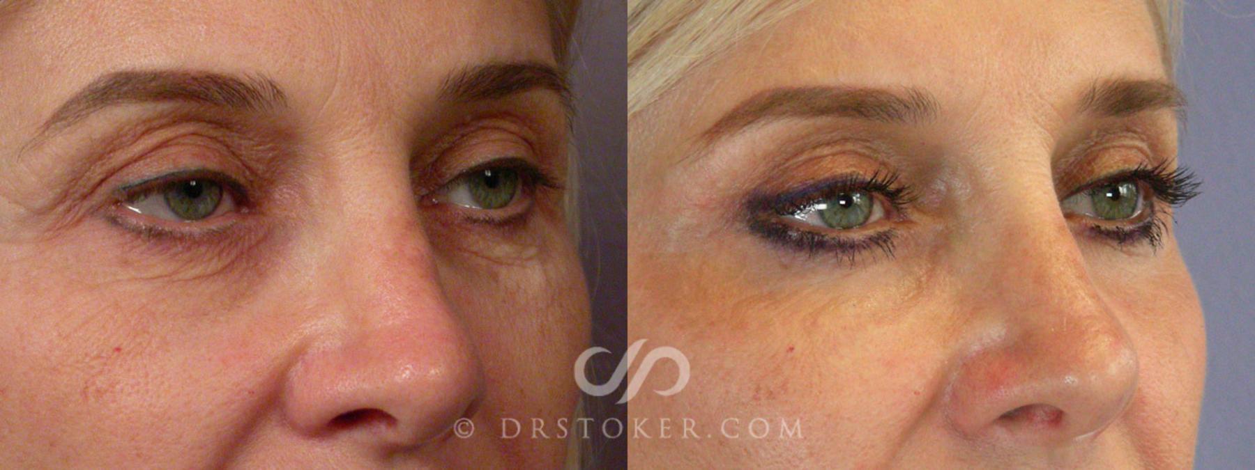 Before & After Facelift - Traceless Facelift Case 255 View #7 View in Los Angeles, CA