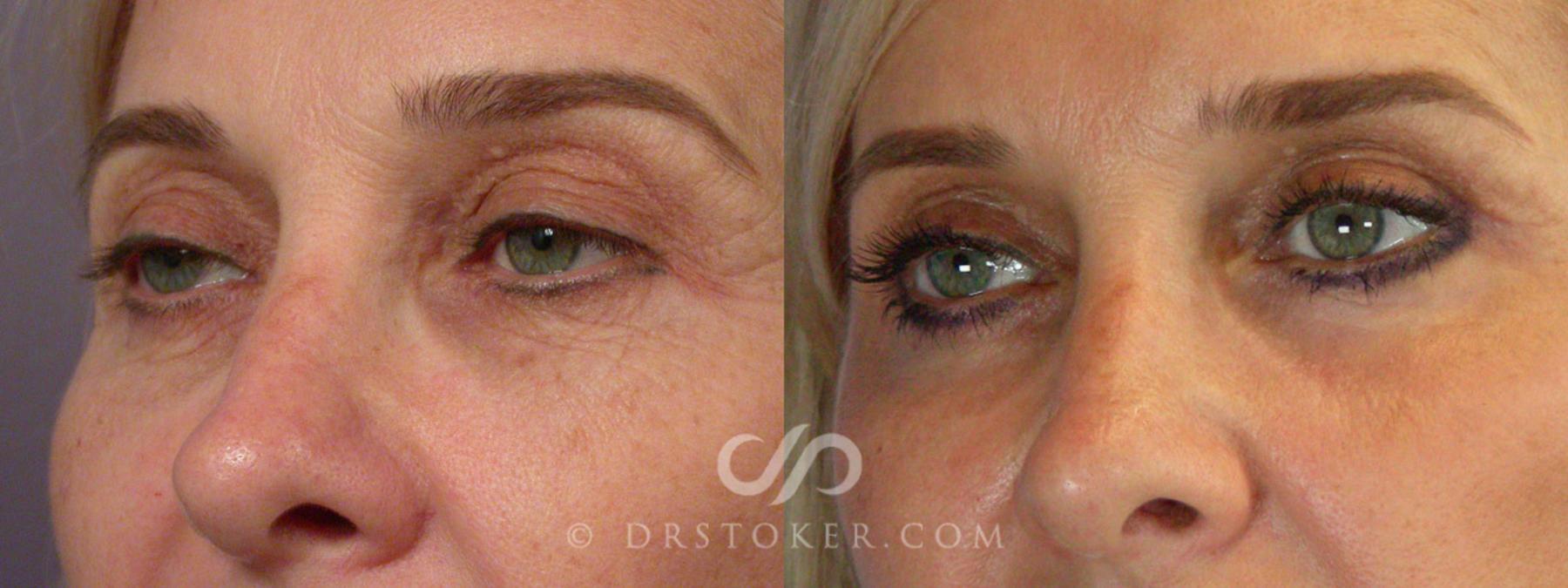 Before & After Laser Skin Resurfacing Case 255 View #8 View in Los Angeles, CA