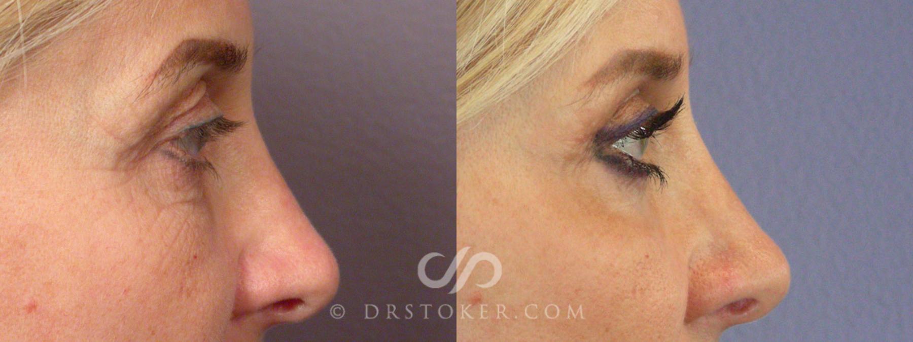 Before & After Facelift - Traceless Facelift Case 255 View #9 View in Los Angeles, CA