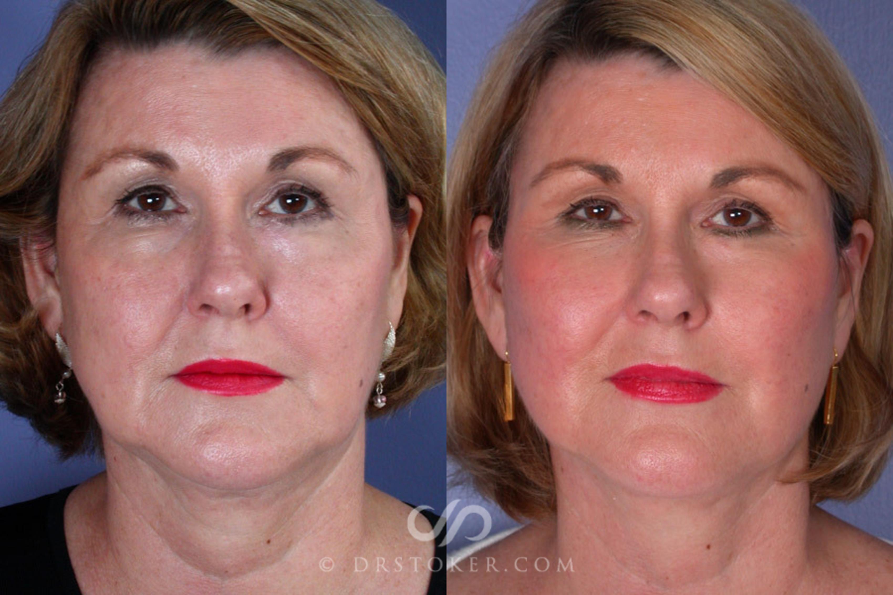 Before & After Facelift - Traceless Facelift Case 256 View #1 View in Los Angeles, CA