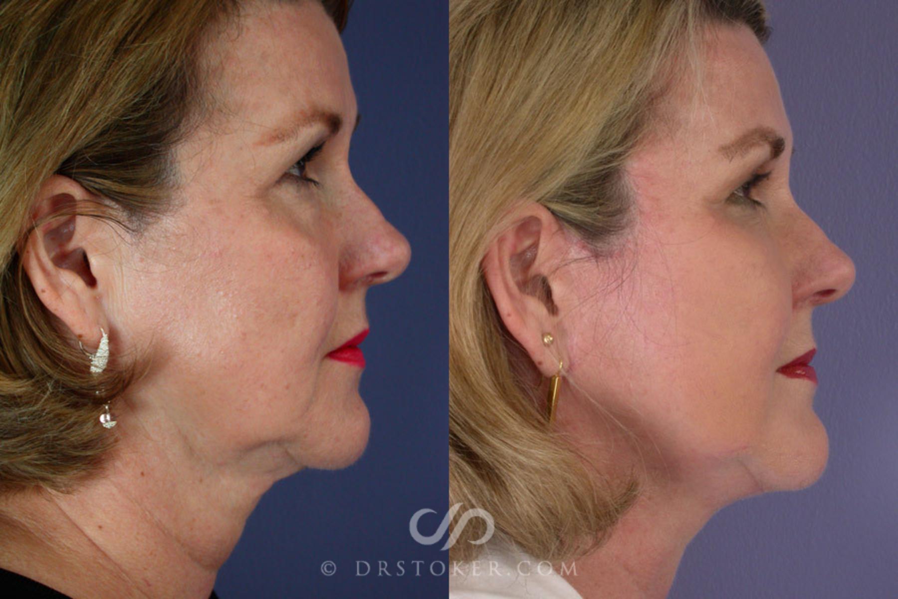 Before & After Facelift - Traceless Facelift Case 256 View #2 View in Los Angeles, CA