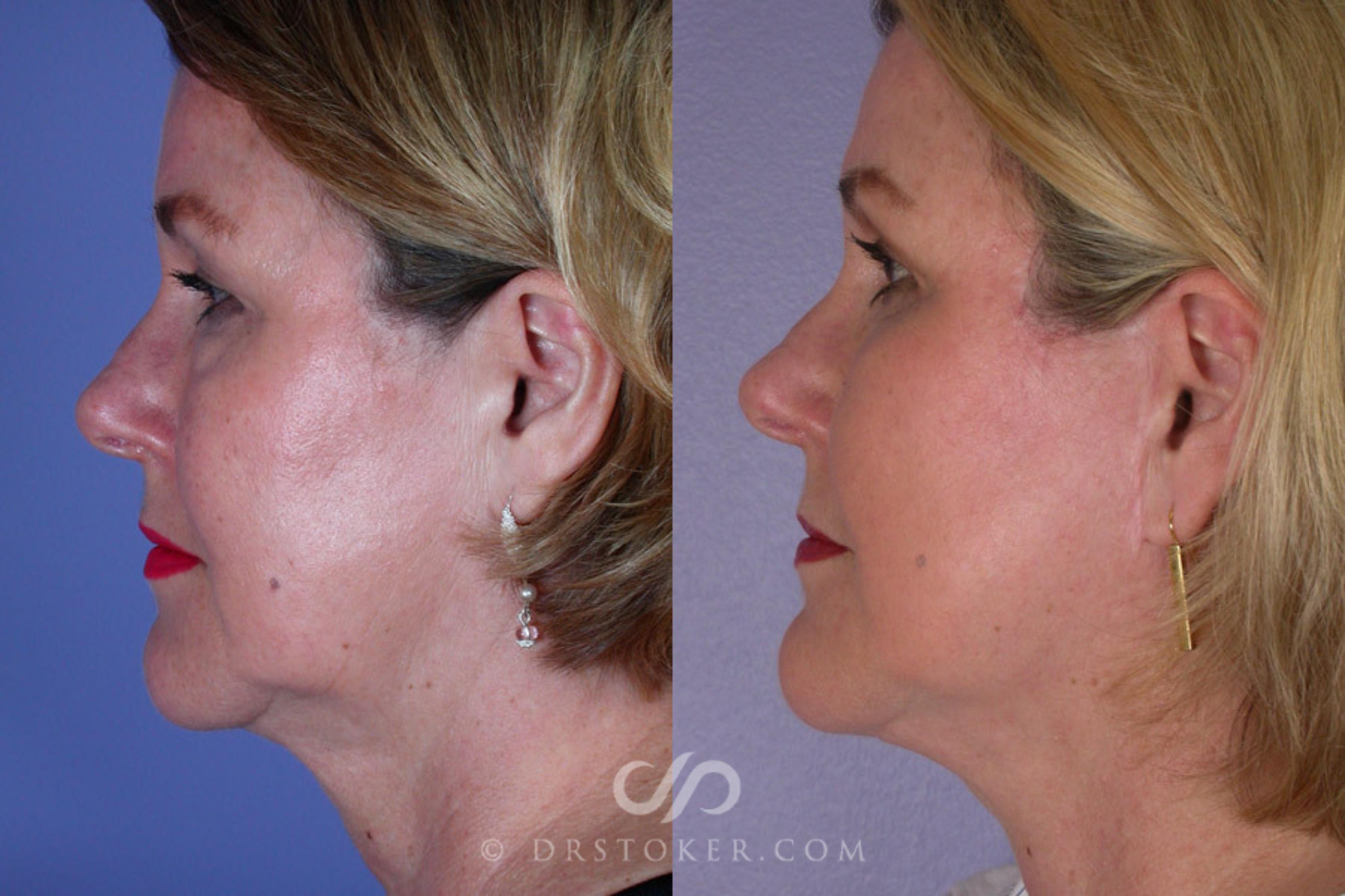 Before & After Facelift - Traceless Facelift Case 256 View #3 View in Los Angeles, CA