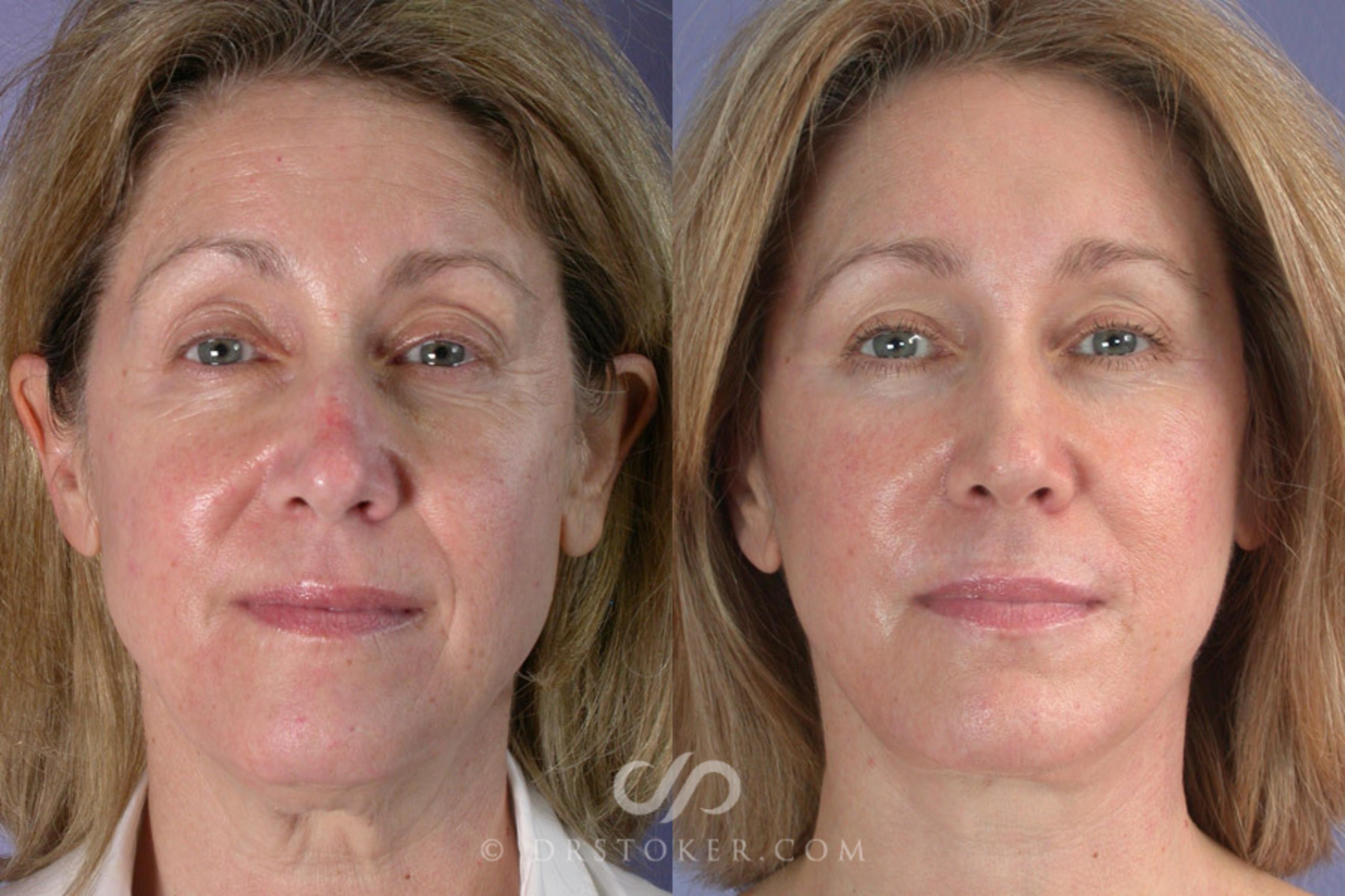 Before & After Facelift - Traceless Facelift Case 257 View #1 View in Los Angeles, CA