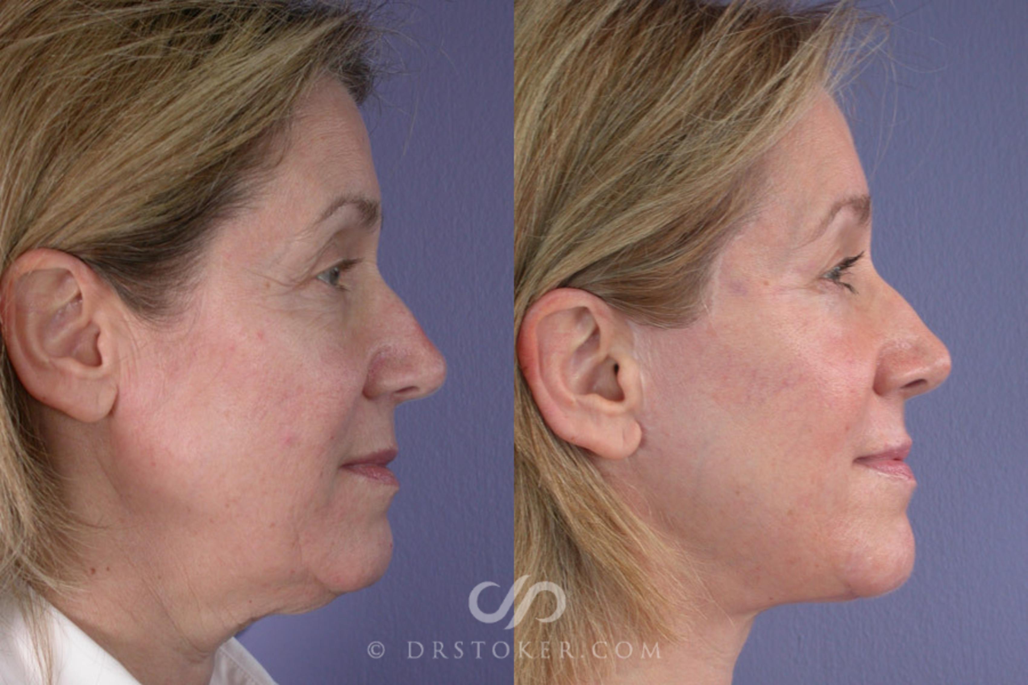 Before & After Facelift - Traceless Facelift Case 257 View #2 View in Los Angeles, CA