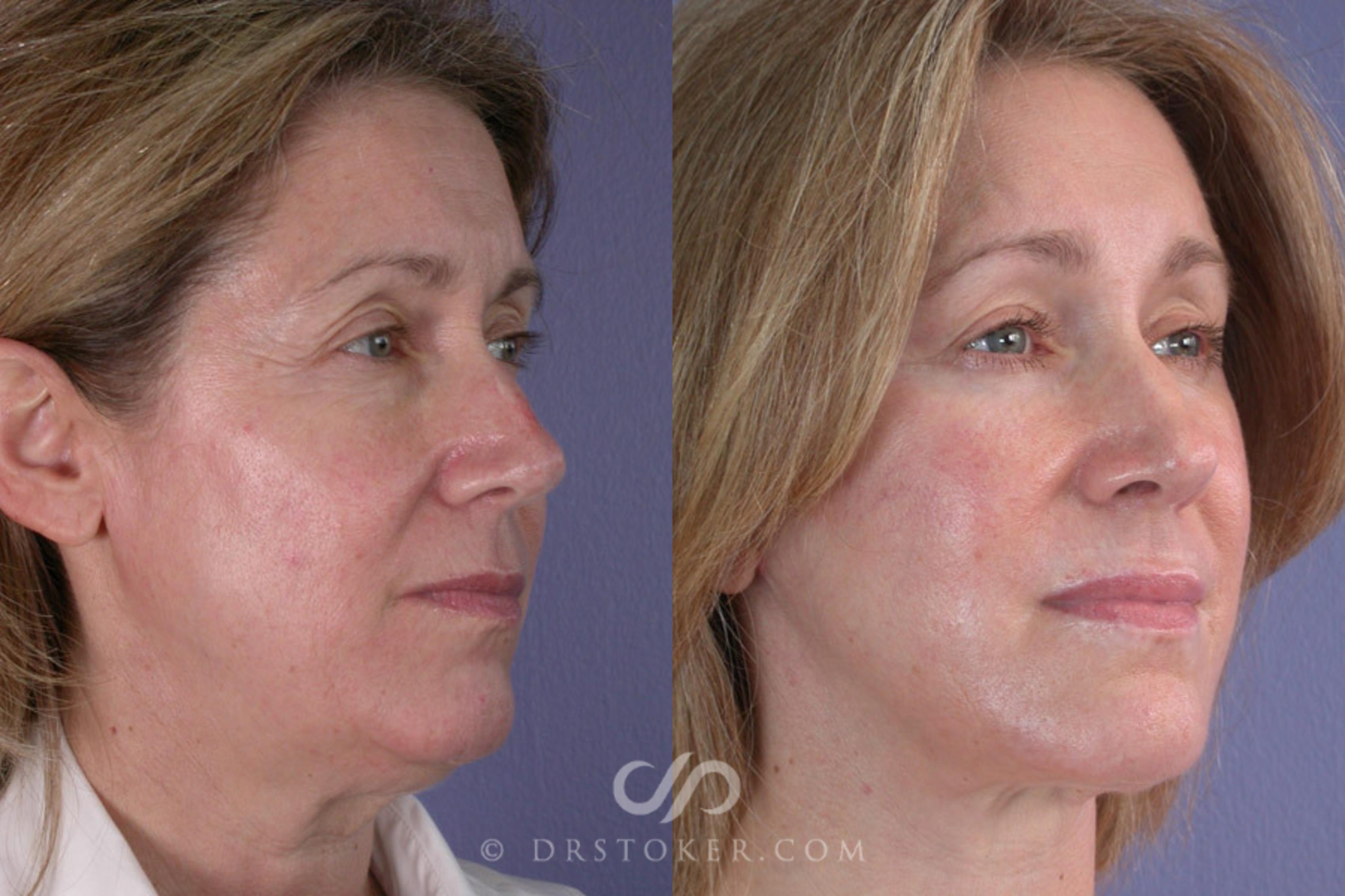 Before & After Facelift - Traceless Facelift Case 257 View #3 View in Los Angeles, CA