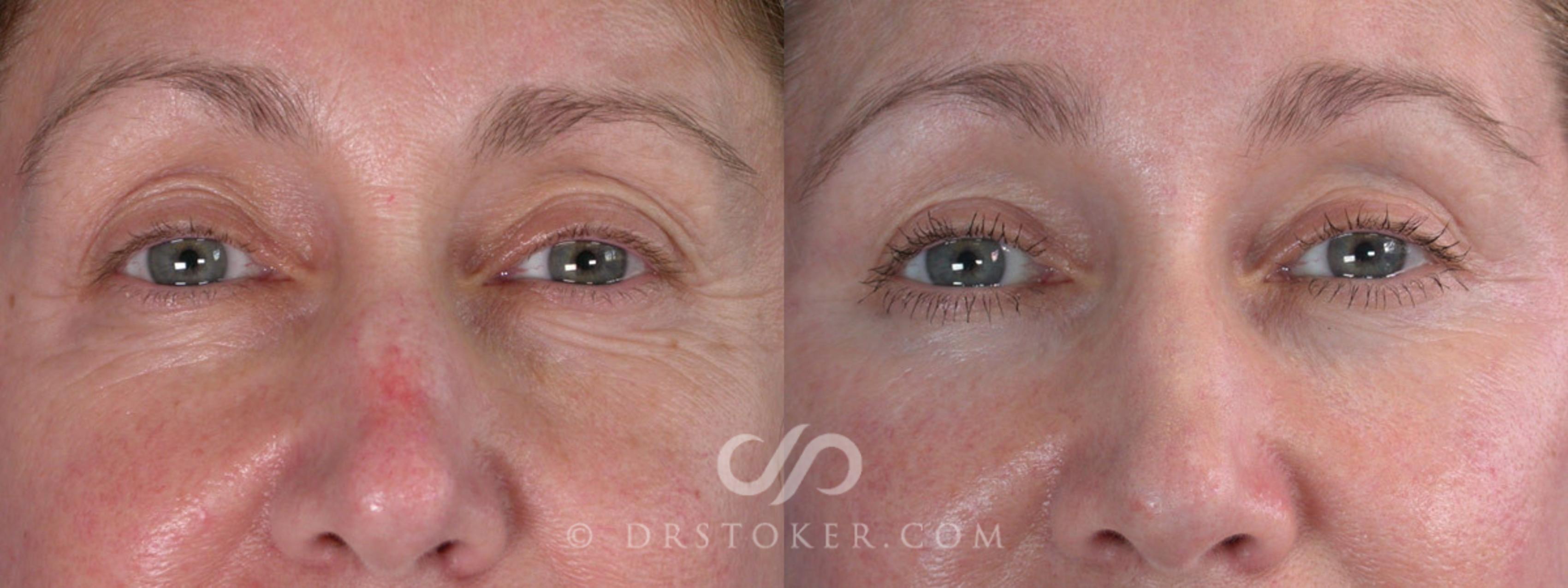 Before & After Facelift - Traceless Facelift Case 257 View #5 View in Los Angeles, CA