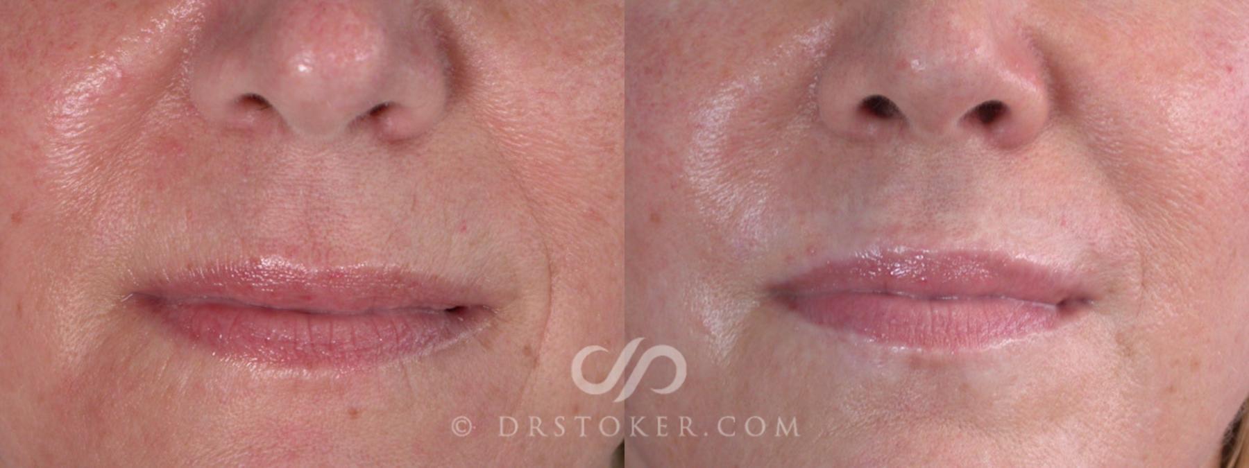 Before & After Eyelid Surgery Case 257 View #6 View in Los Angeles, CA