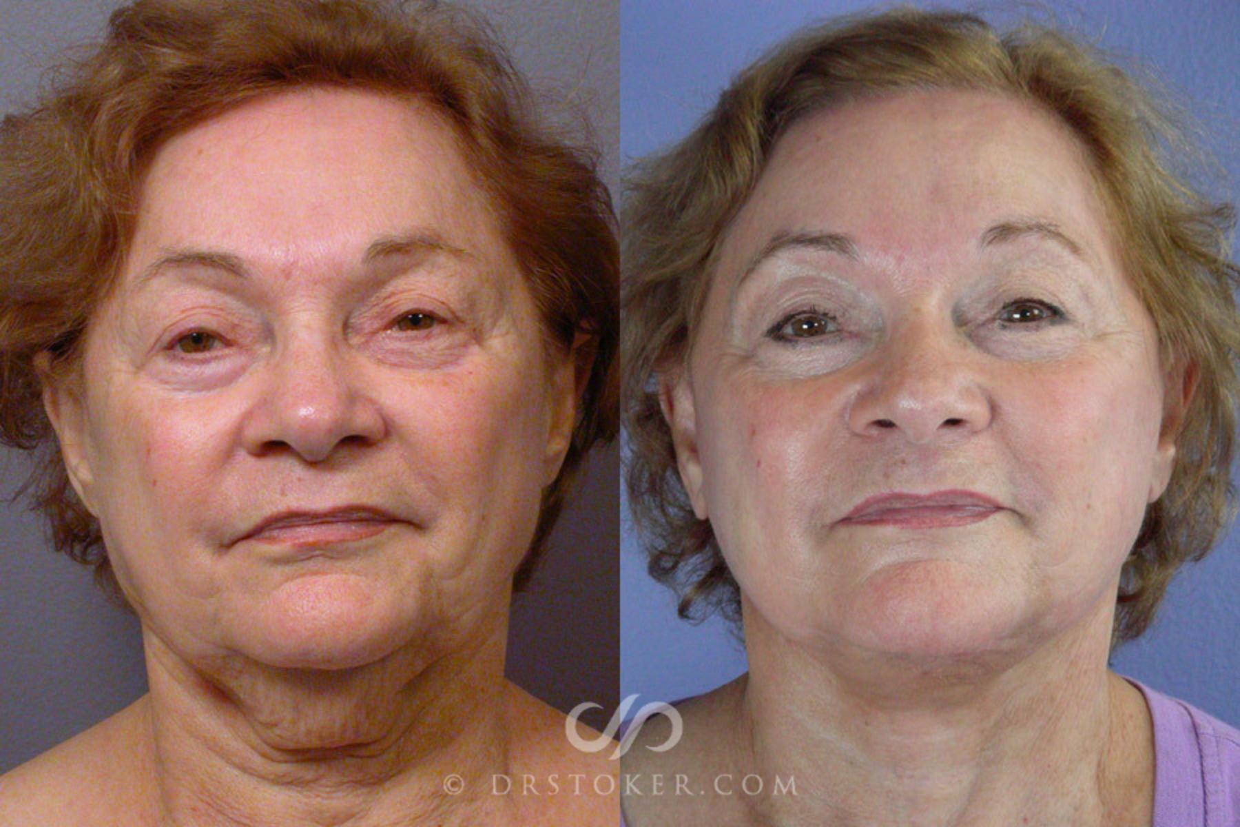 Before & After Facelift - Traceless Facelift Case 323 View #1 View in Los Angeles, CA
