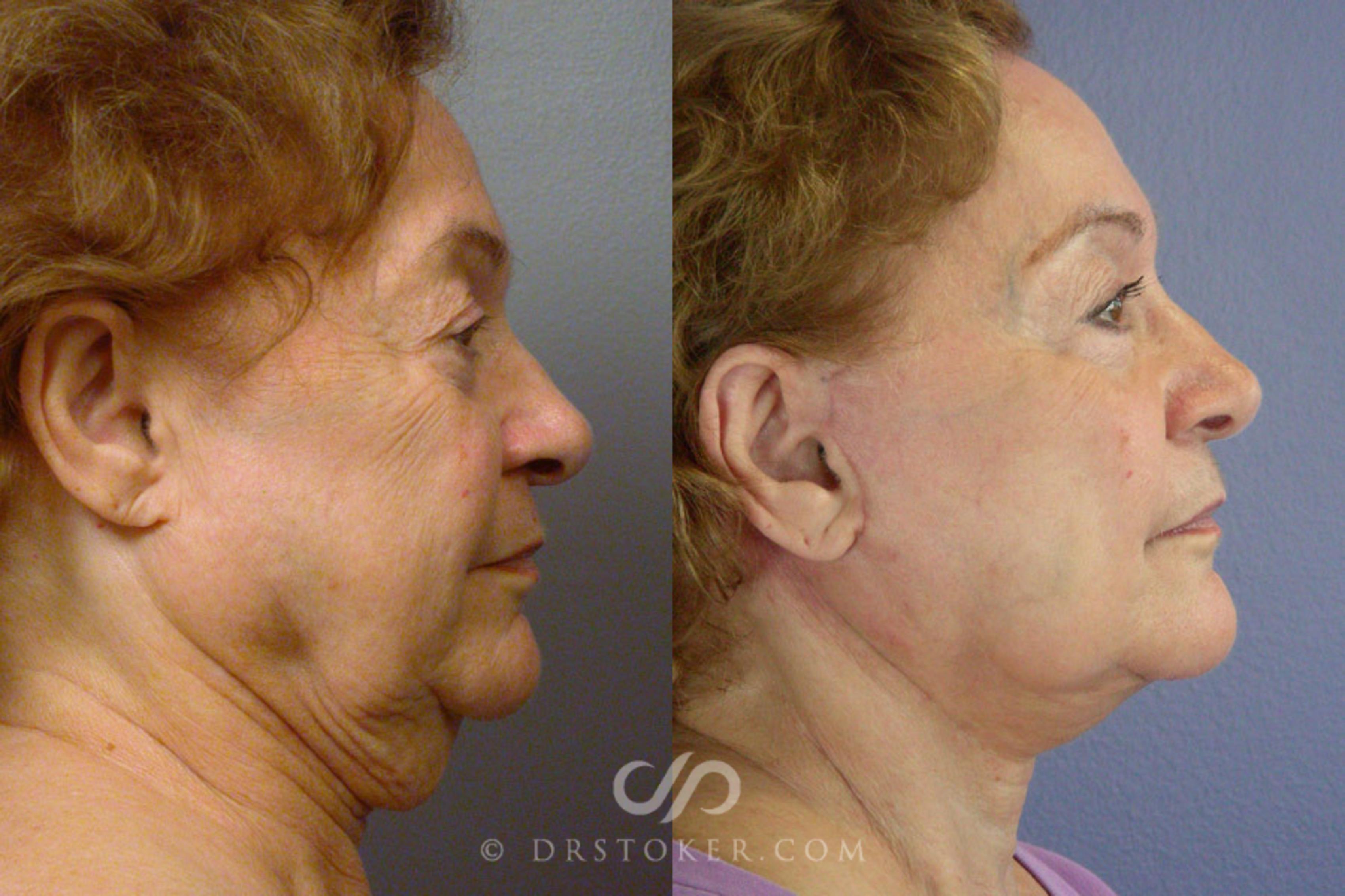 Before & After Facelift - Traceless Facelift Case 323 View #2 View in Los Angeles, CA